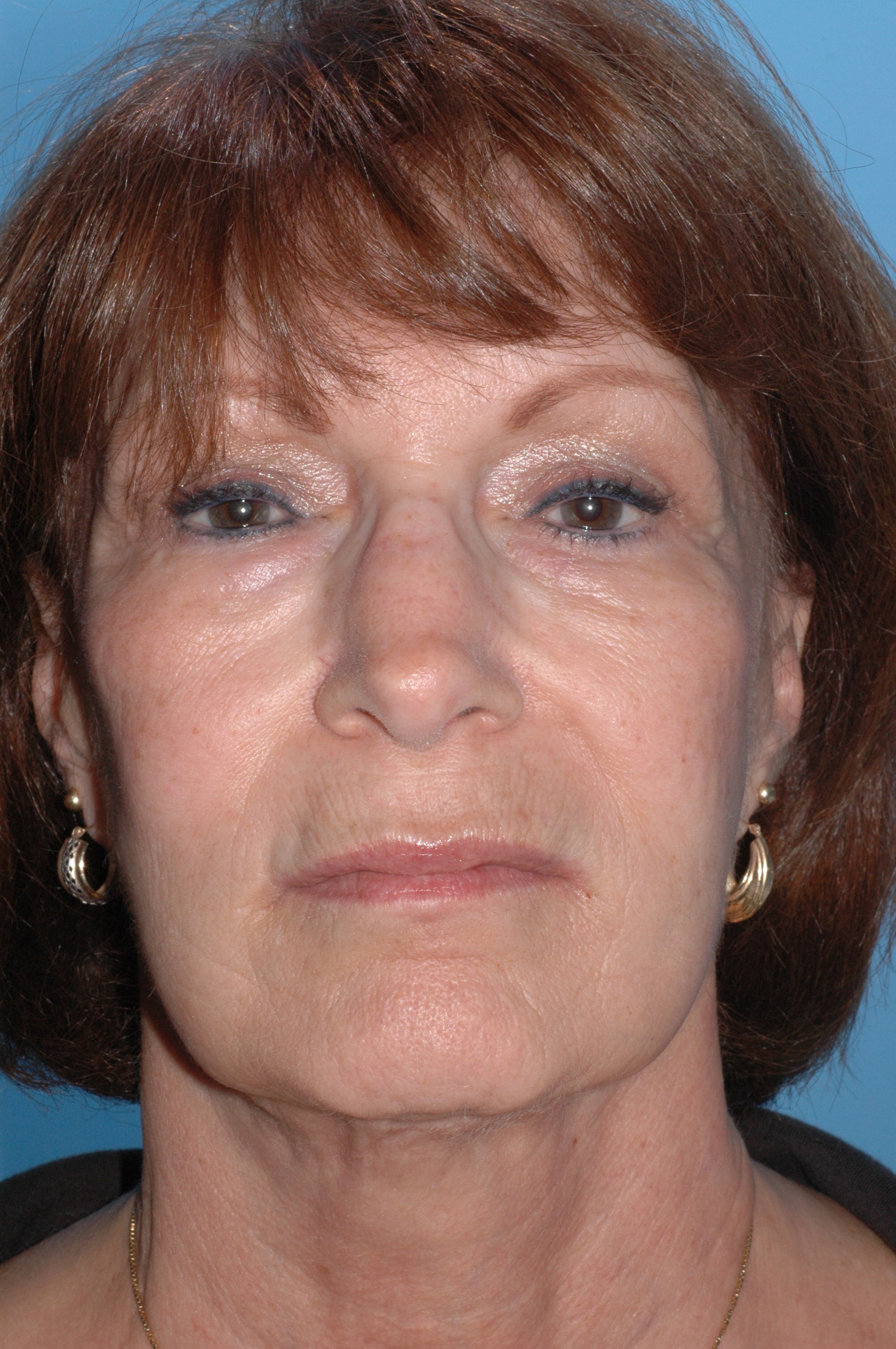 BEFORE: rhinoplasty: wide nasal bones, dorsal convexity, ptotic nasal tip