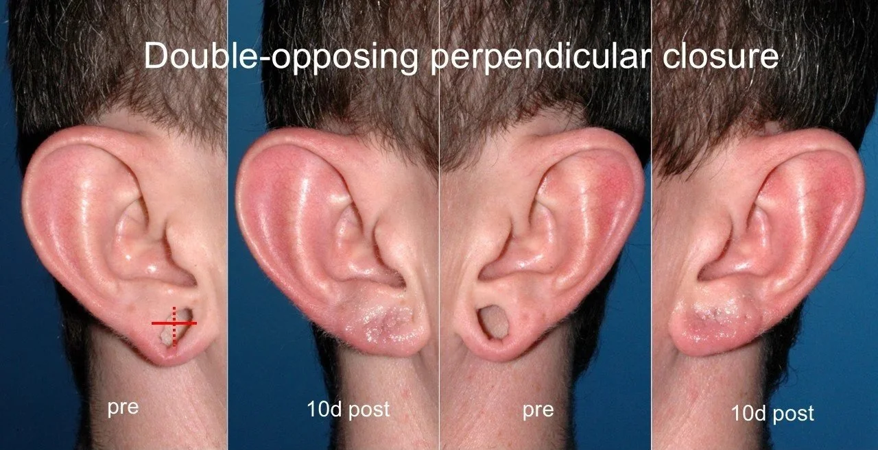 Repair of gauge earring defect with double perpendicular line closure