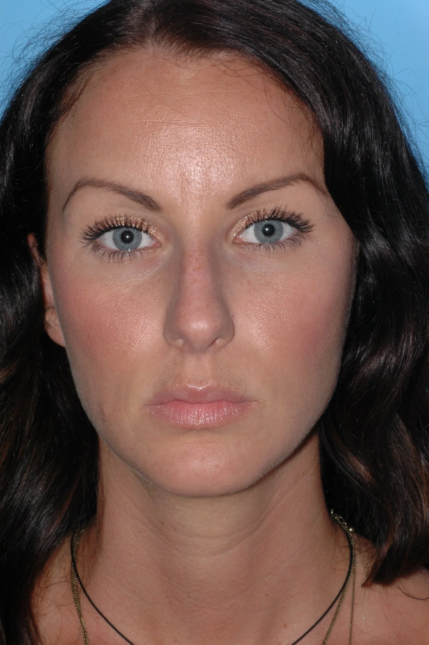 BEFORE rhinoplasty (overprojected dorsum,  functional issues)