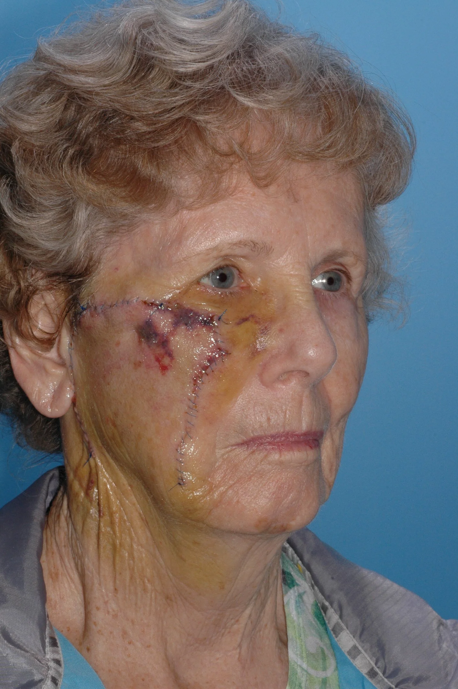 1 wk AFTER: cervical facial rotation flap