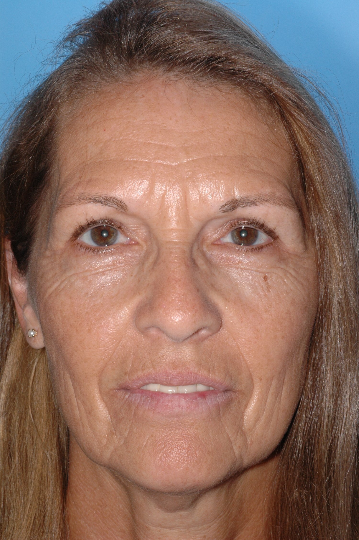 AFTER upper lid blepharoplasty