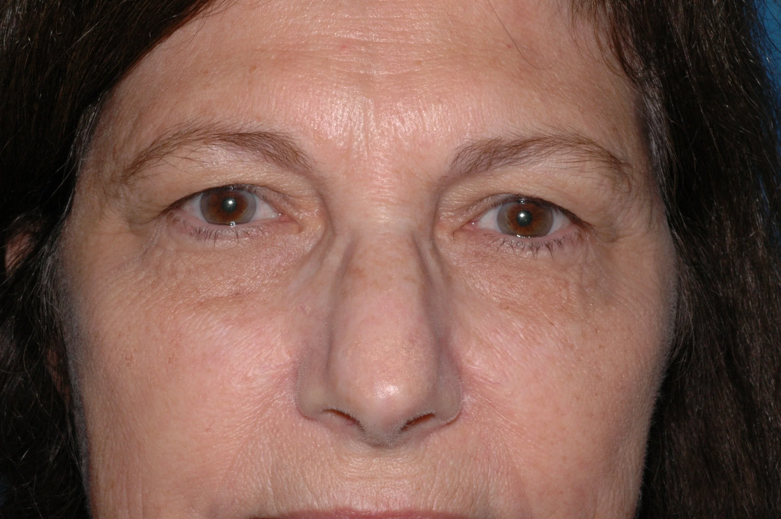 BEFORE: hooded upper lids