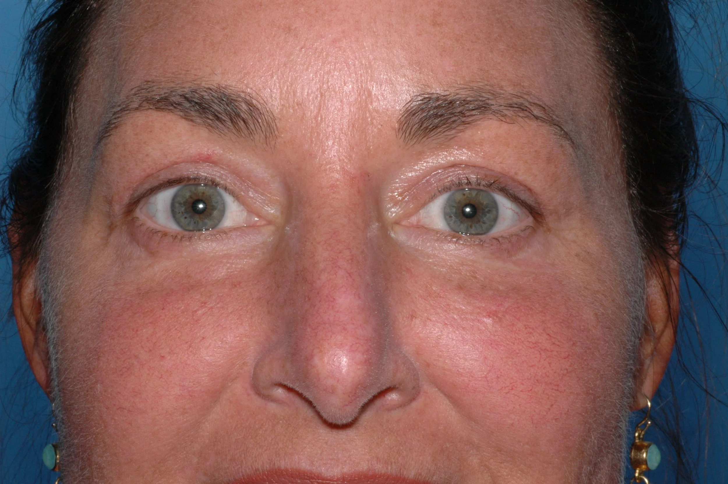 AFTER upper eyelid blepharoplasty