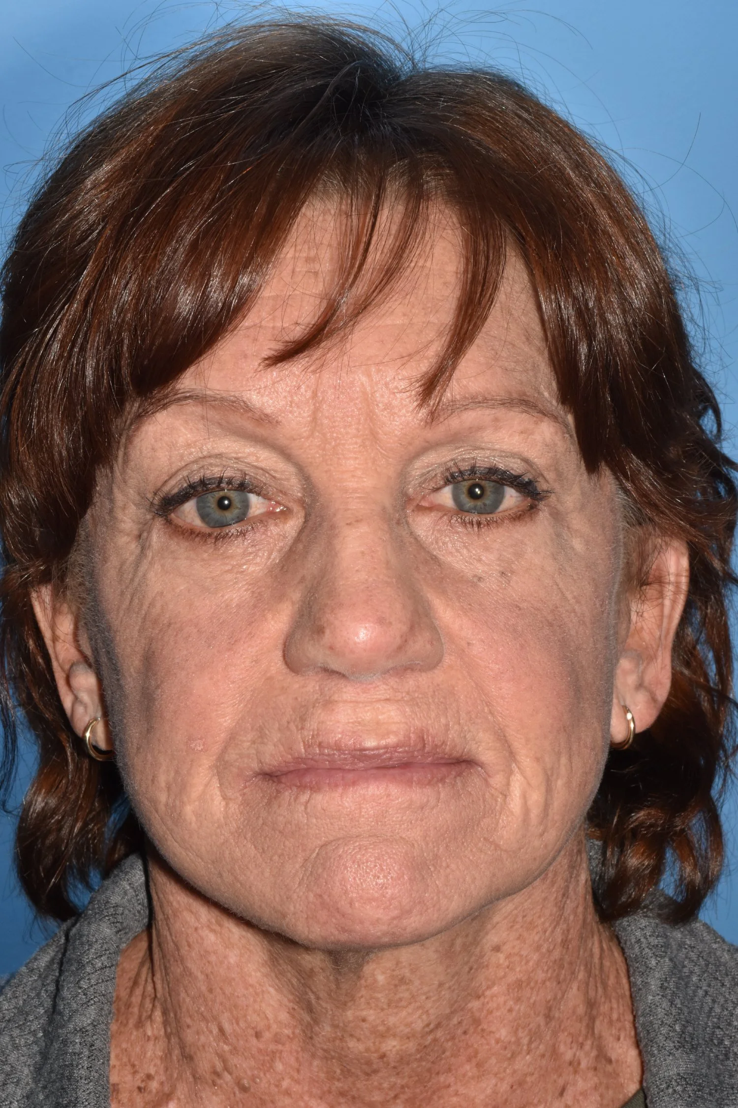 AFTER, Lower lid fat repositioning bleph, facelift