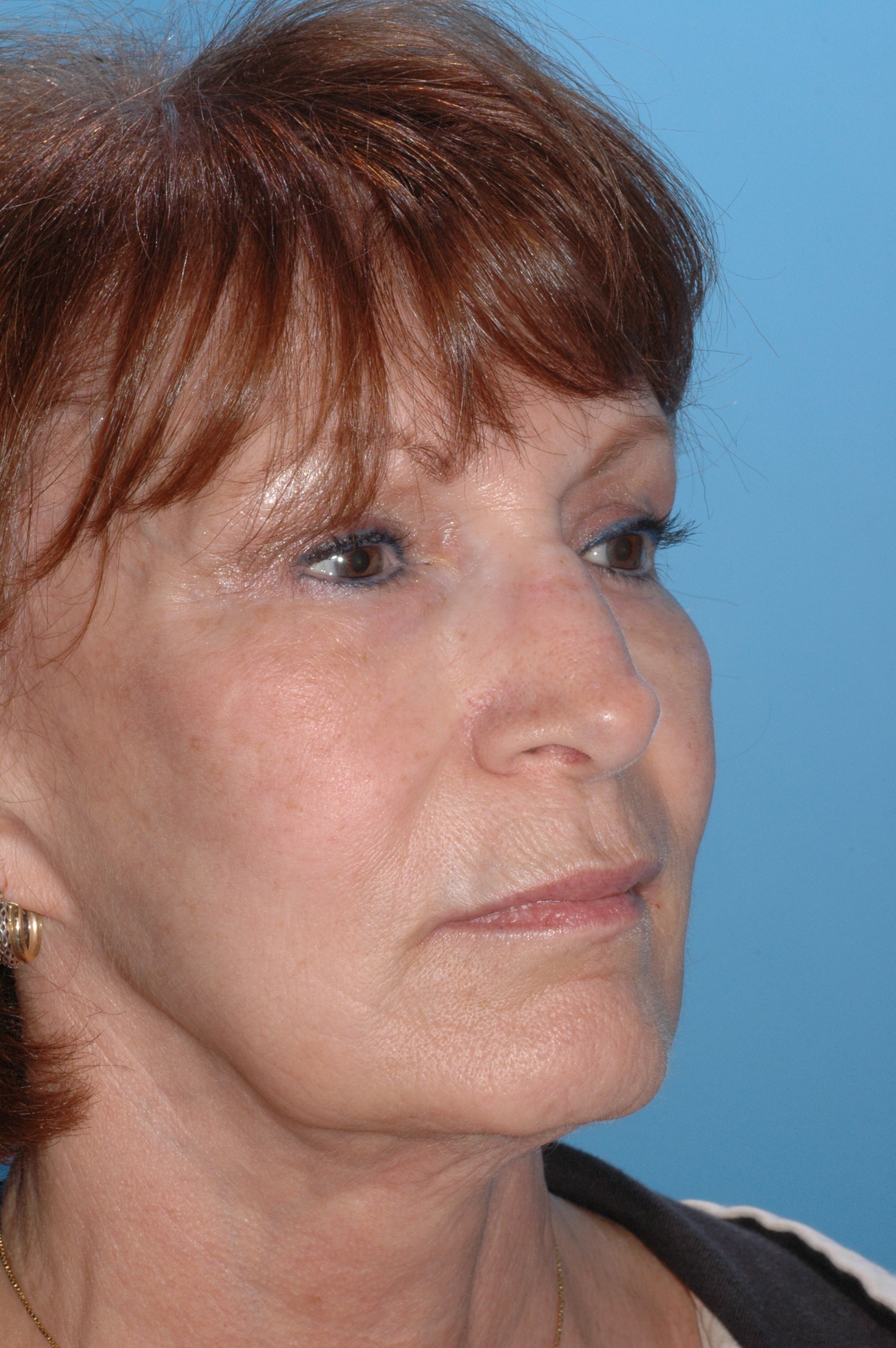 BEFORE: rhinoplasty: wide nasal bones, dorsal convexity, ptotic nasal tip