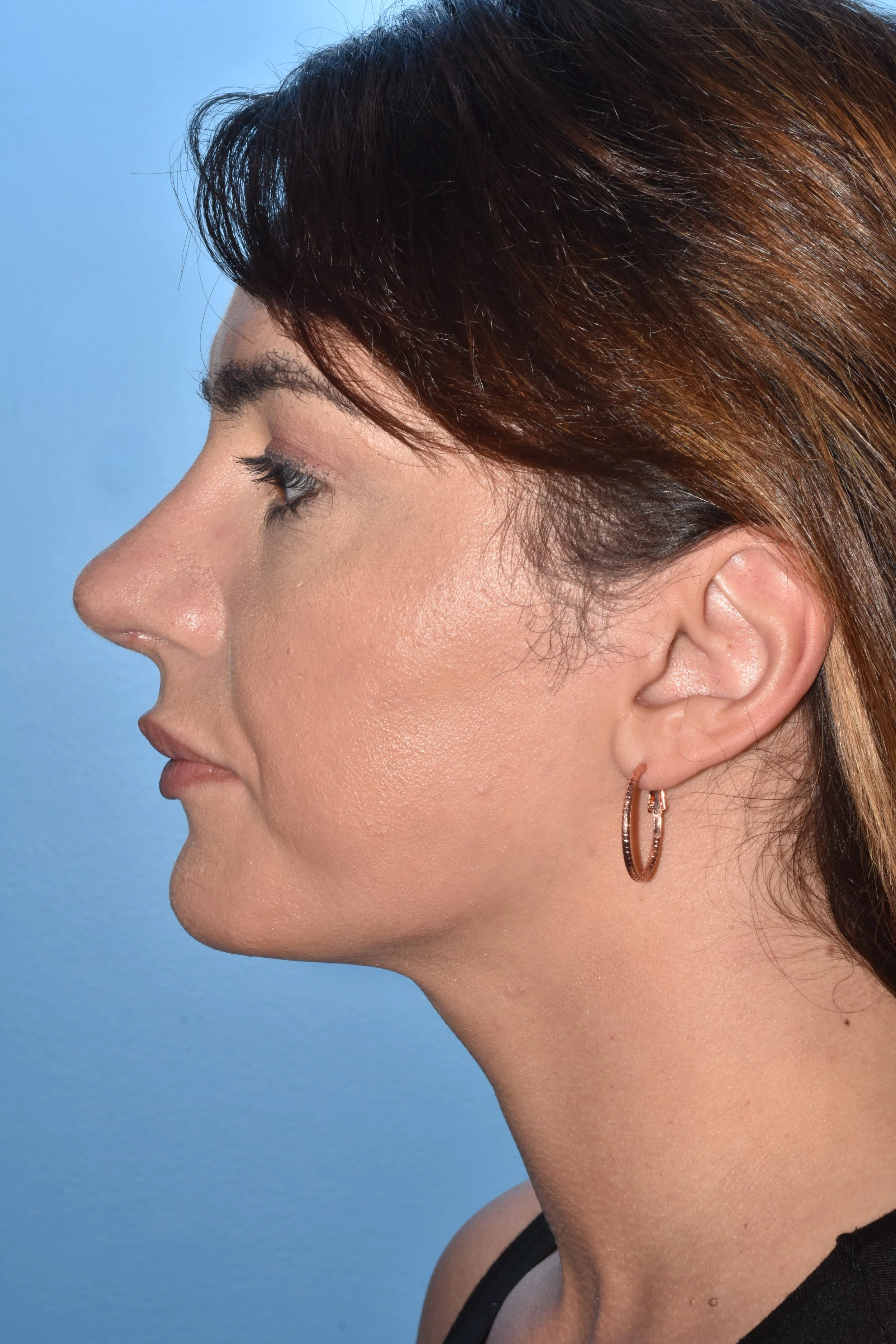 AFTER rhinoplasty (hump reduction, tip elevation, tip narrowing, straighter dorsum)
