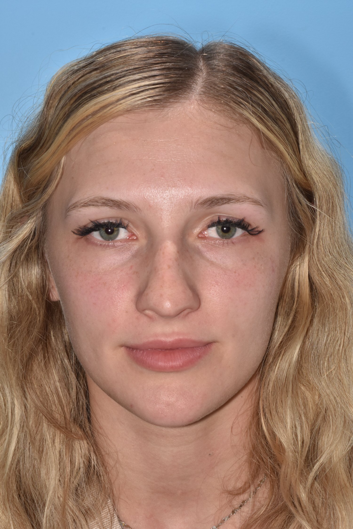 BEFORE rhinoplasty