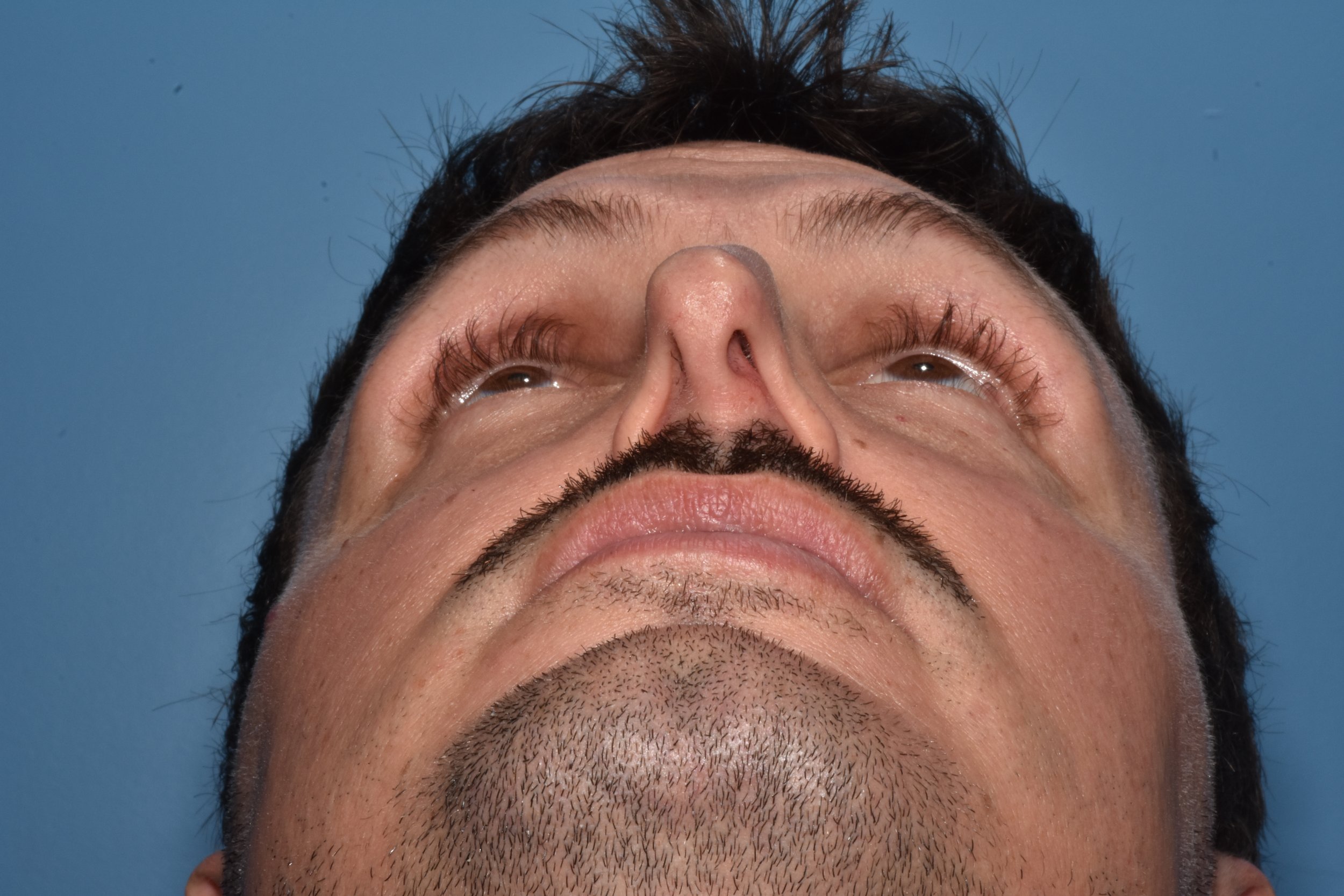 BEFORE (external nasal valve collapse with inspiration)