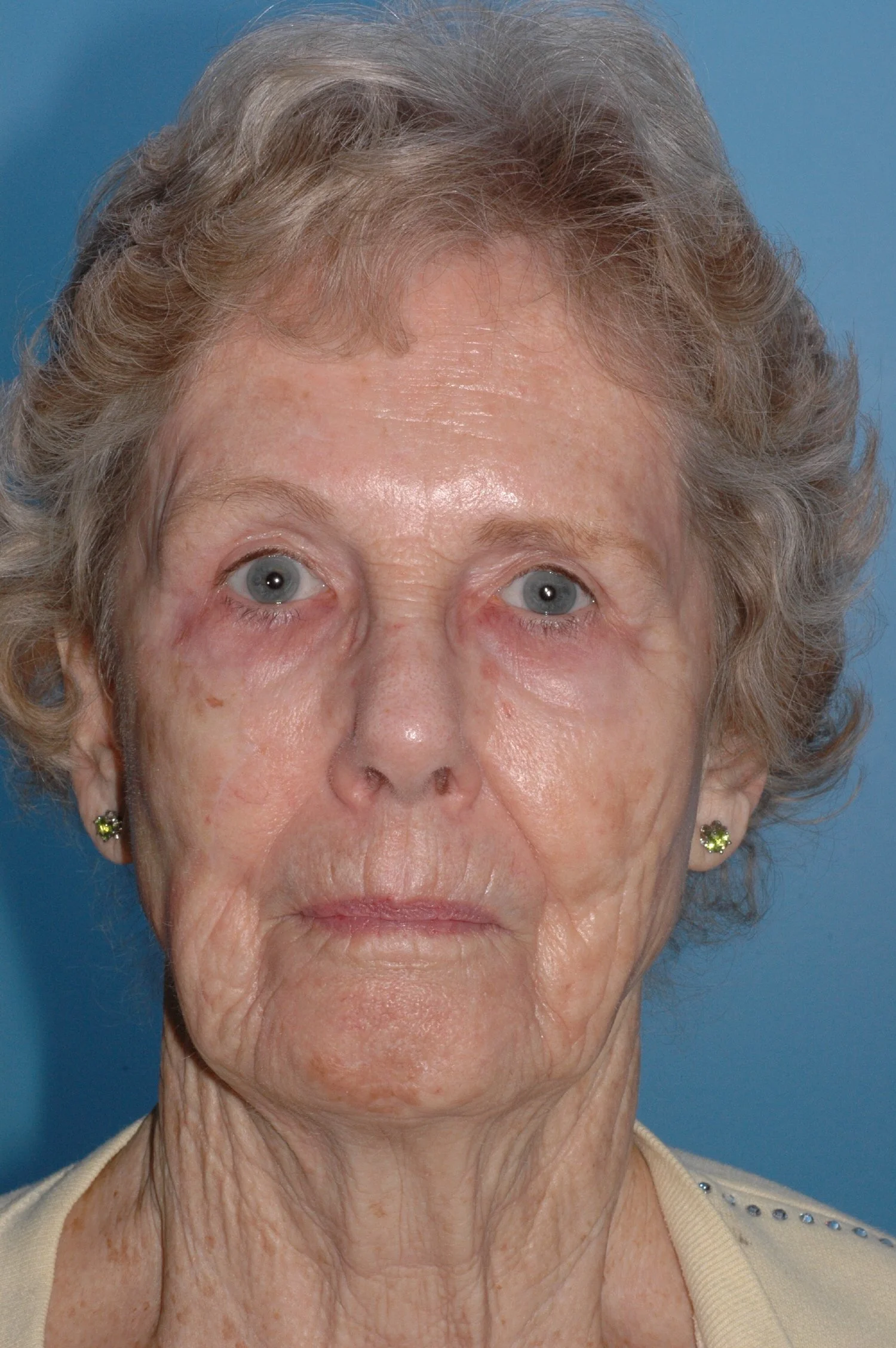 1 y AFTER: cervical facial rotation flap
