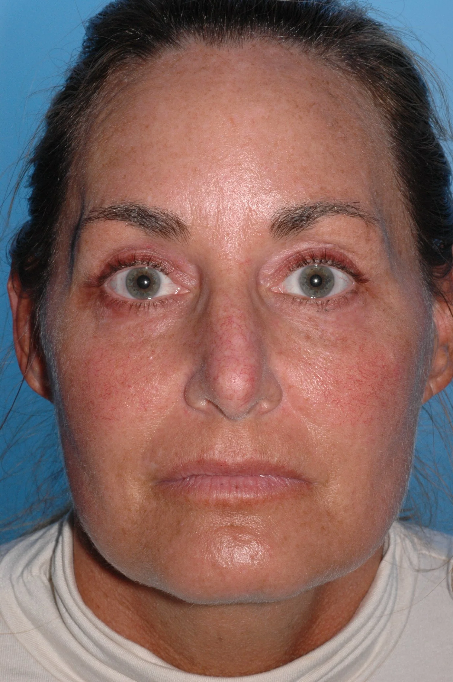 AFTER upper eyelid blepharoplasty