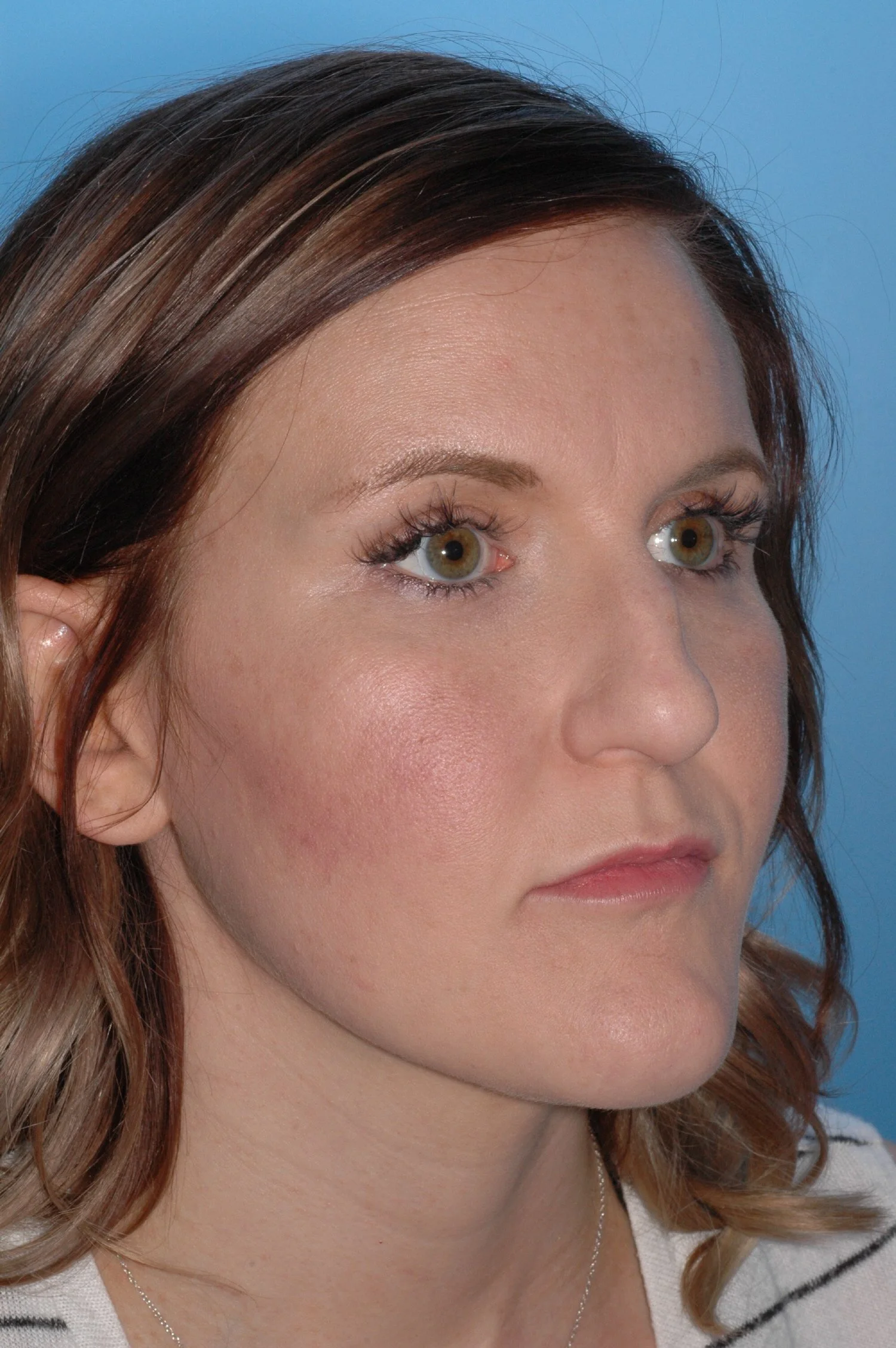 BEFORE: Crooked nose, hump dorsum