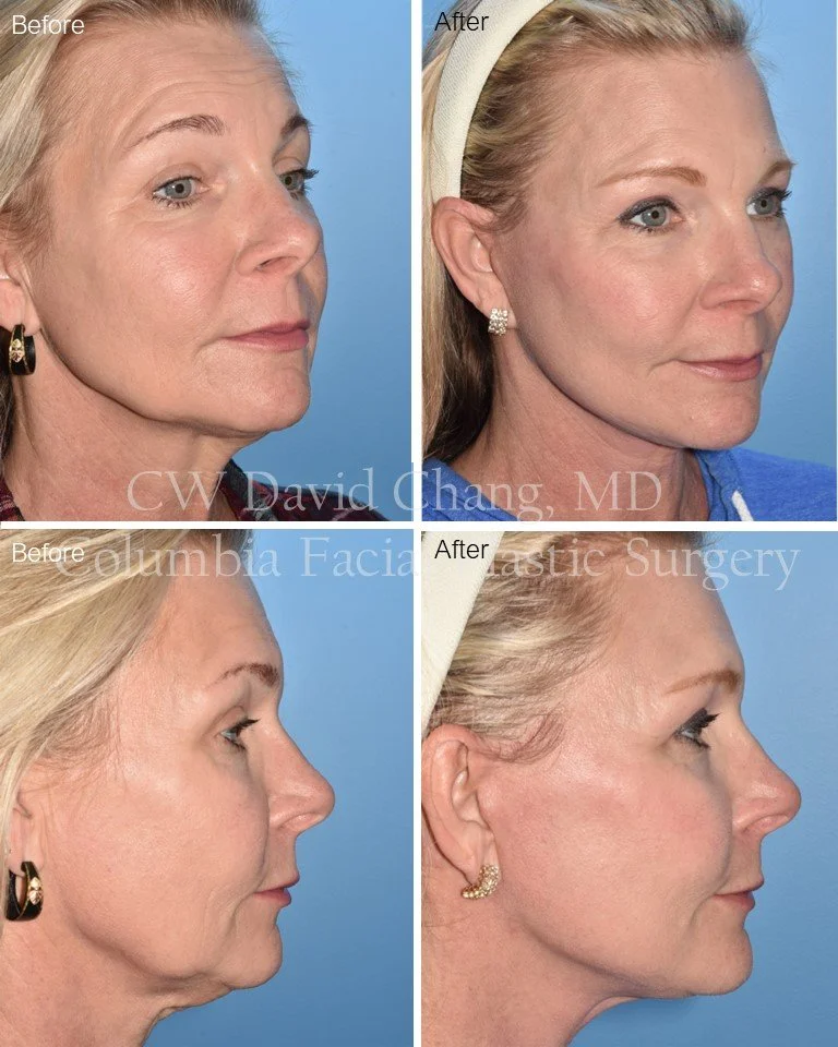 Before and after images of a woman showing facial improvements from plastic surgery (facelift), with noticeable reduction of wrinkles, sagging skin, and a more defined jawline.