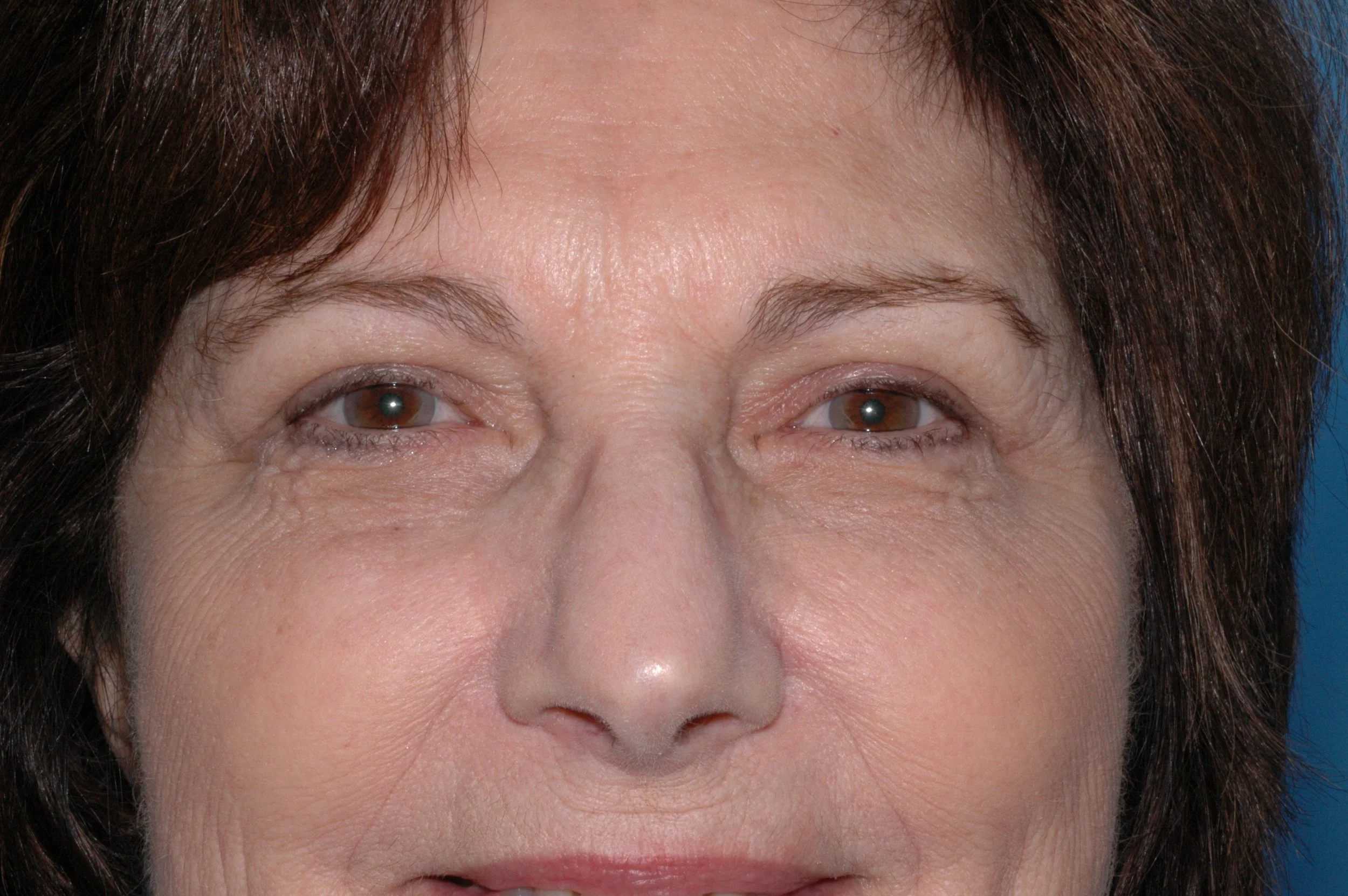 AFTER: upper lid blepharoplasty only