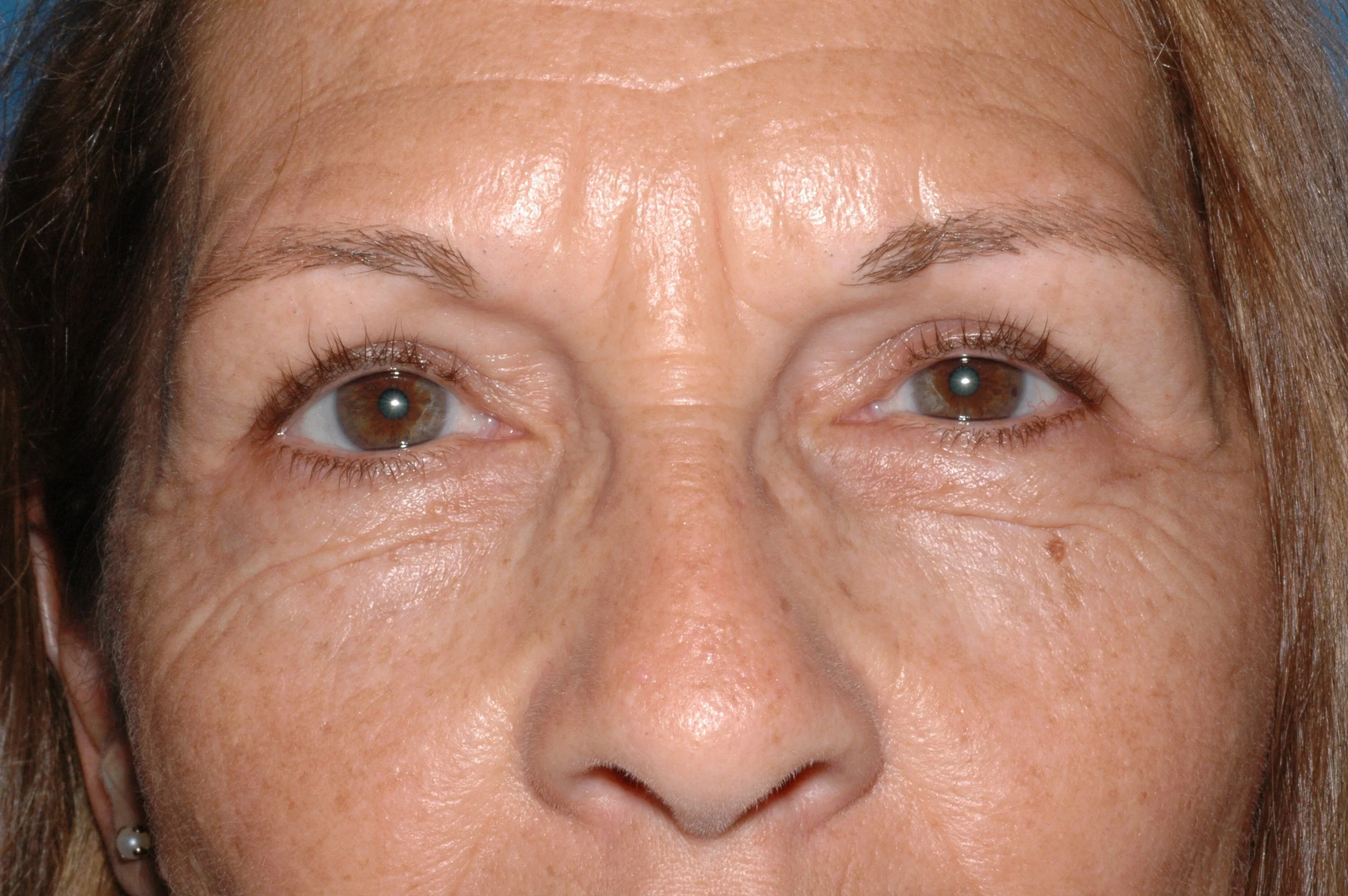 AFTER upper lid blepharoplasty