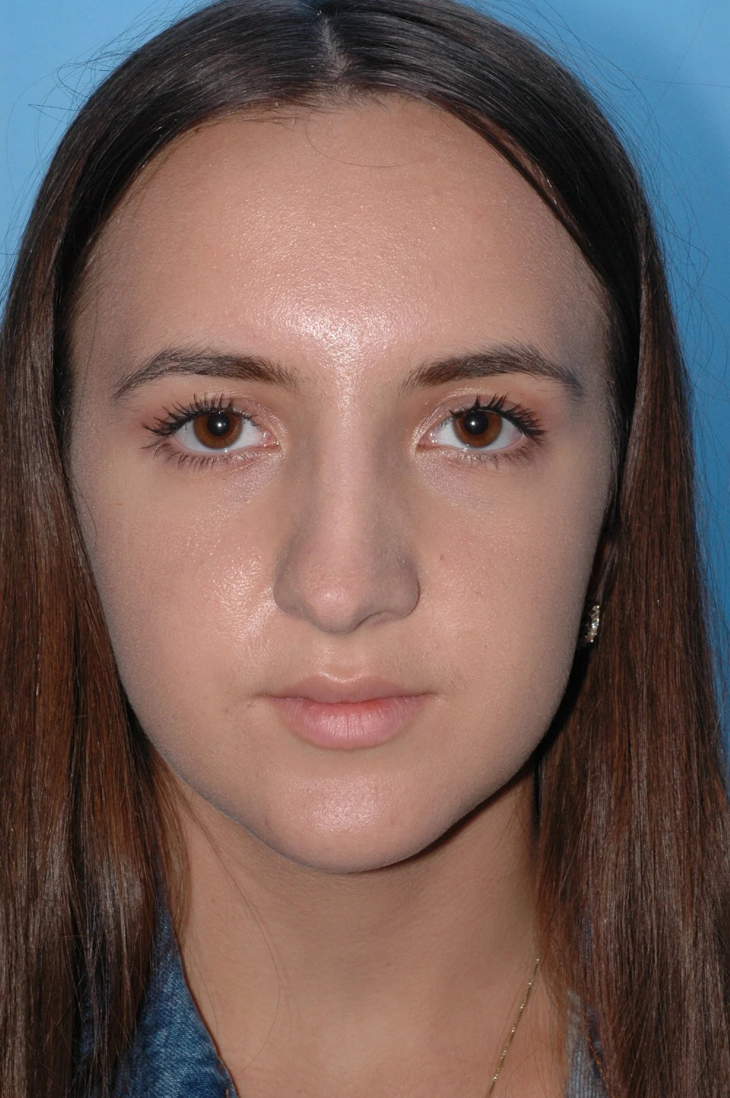 4 y AFTER rhinoplasty: dorsal reduction, tip narrowing, tip elevation