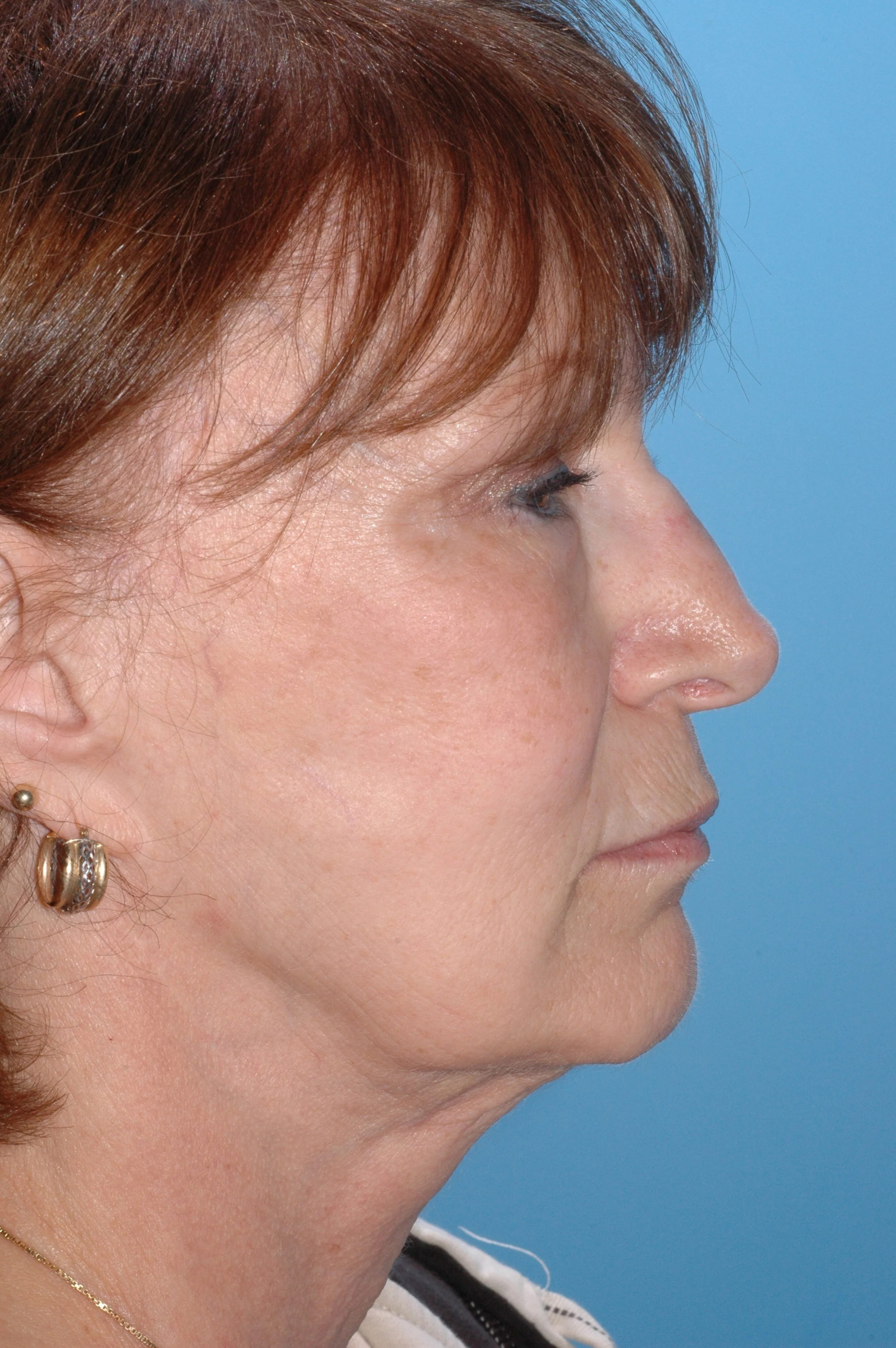 BEFORE: rhinoplasty: wide nasal bones, dorsal convexity, ptotic nasal tip