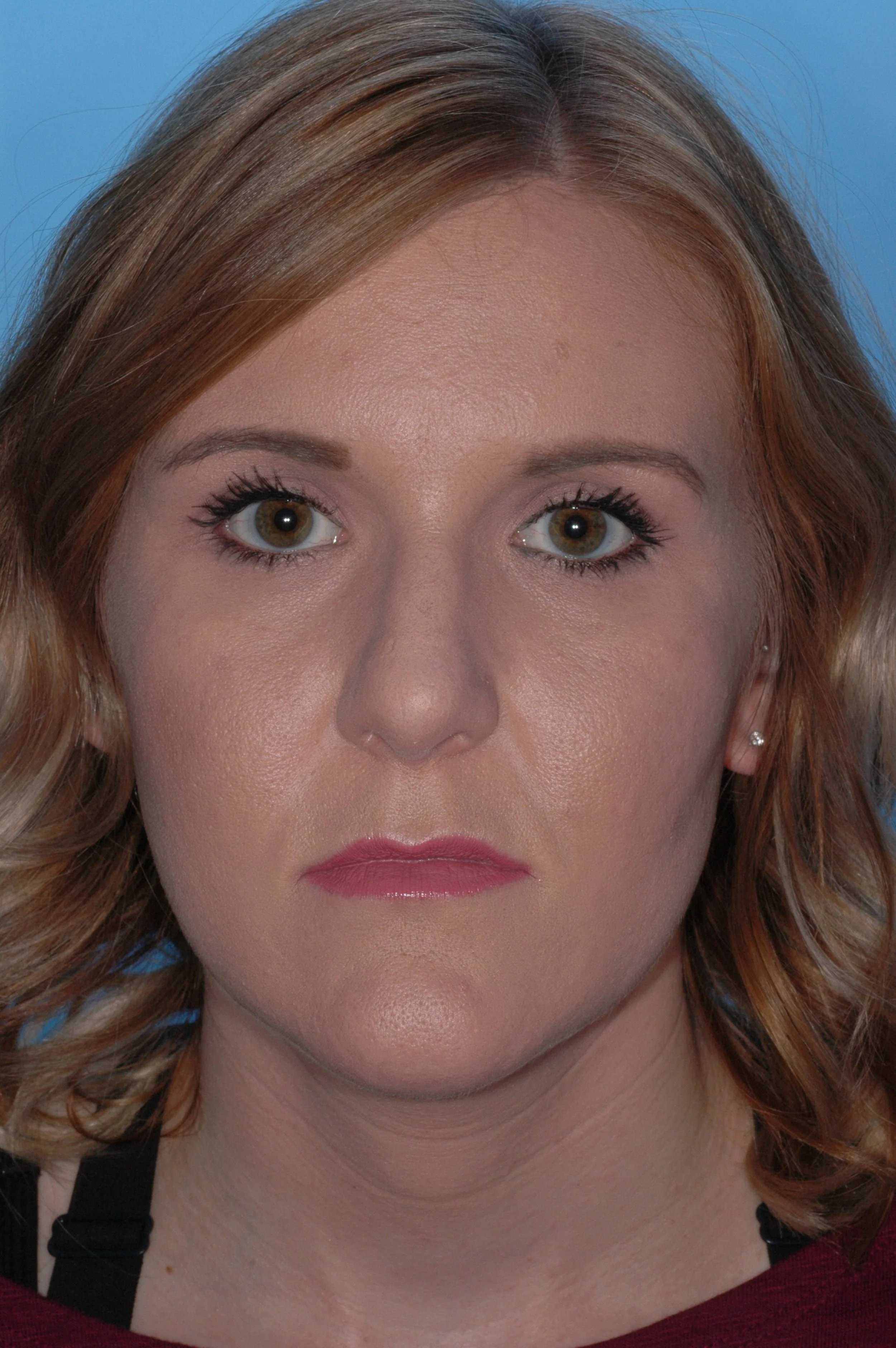 AFTER:  dorsal reduction, cephalic turn in to narrow tip, plumping graft placed in  the premaxilla region, tongue-in-groove for tip support,  clocking sutures