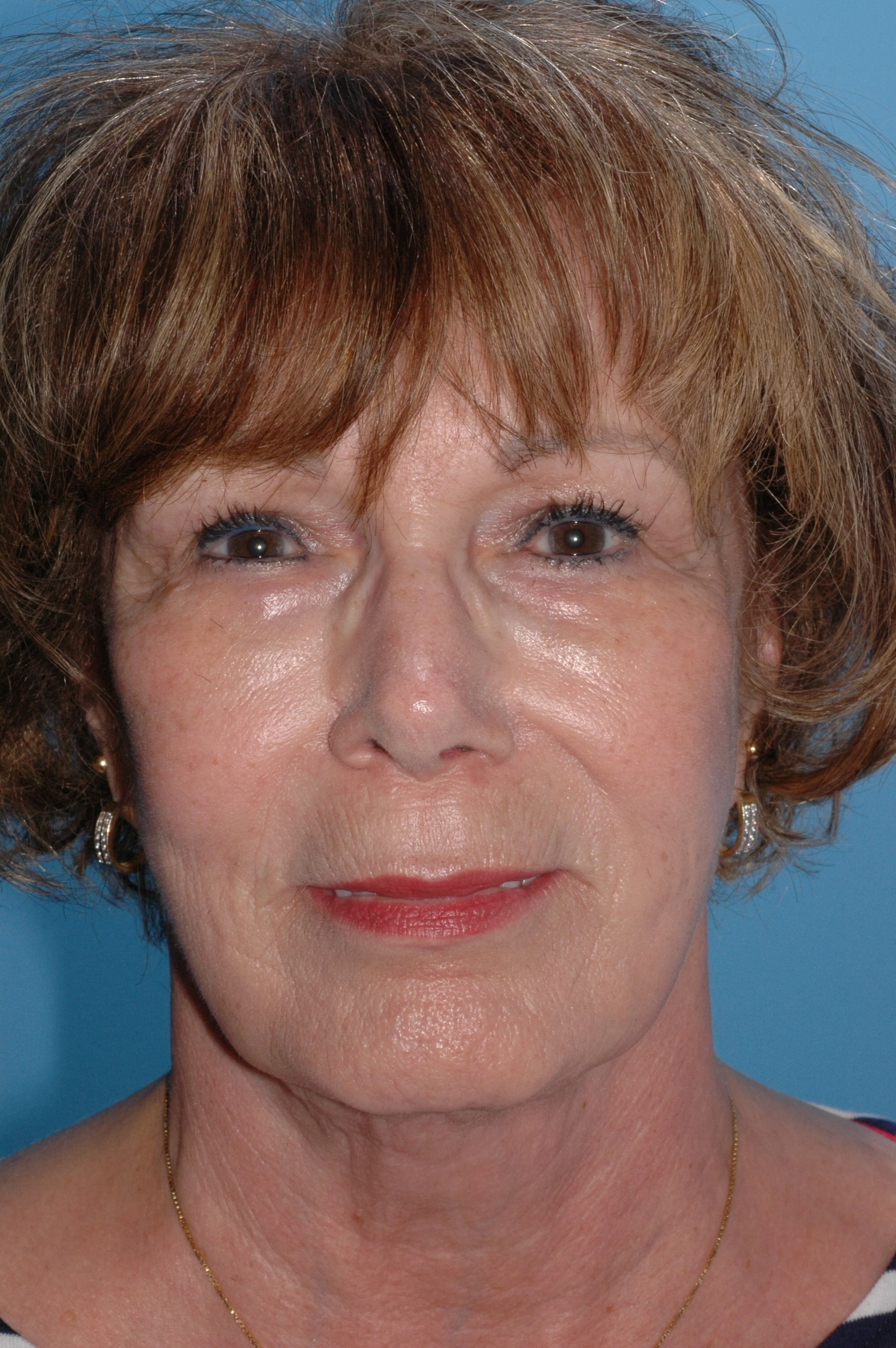 5 y AFTER rhinoplasty: dorsal reduction, medial and lateral osteotomies, tongue-in-groove to recess the medial crus and elevate /rotate tip, onlay graft of cartilage over the superior left nasal tip, L rim graft, 3 mm nasal sill excisions.