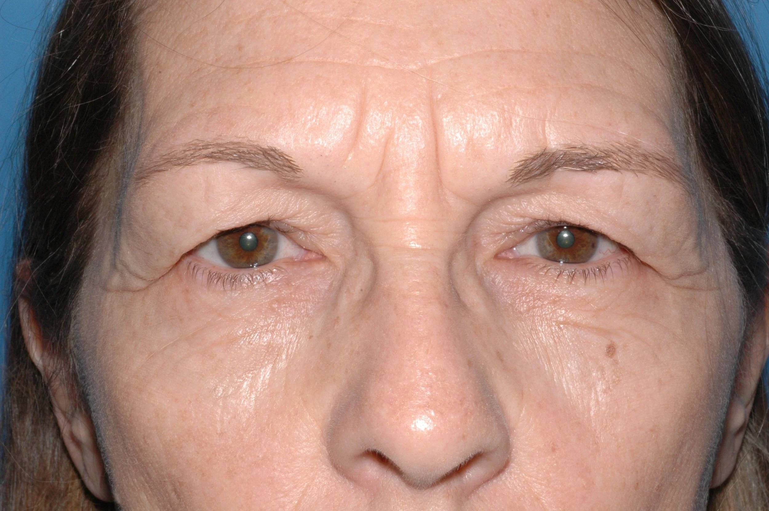 BEFORE upper lid blepharoplasty