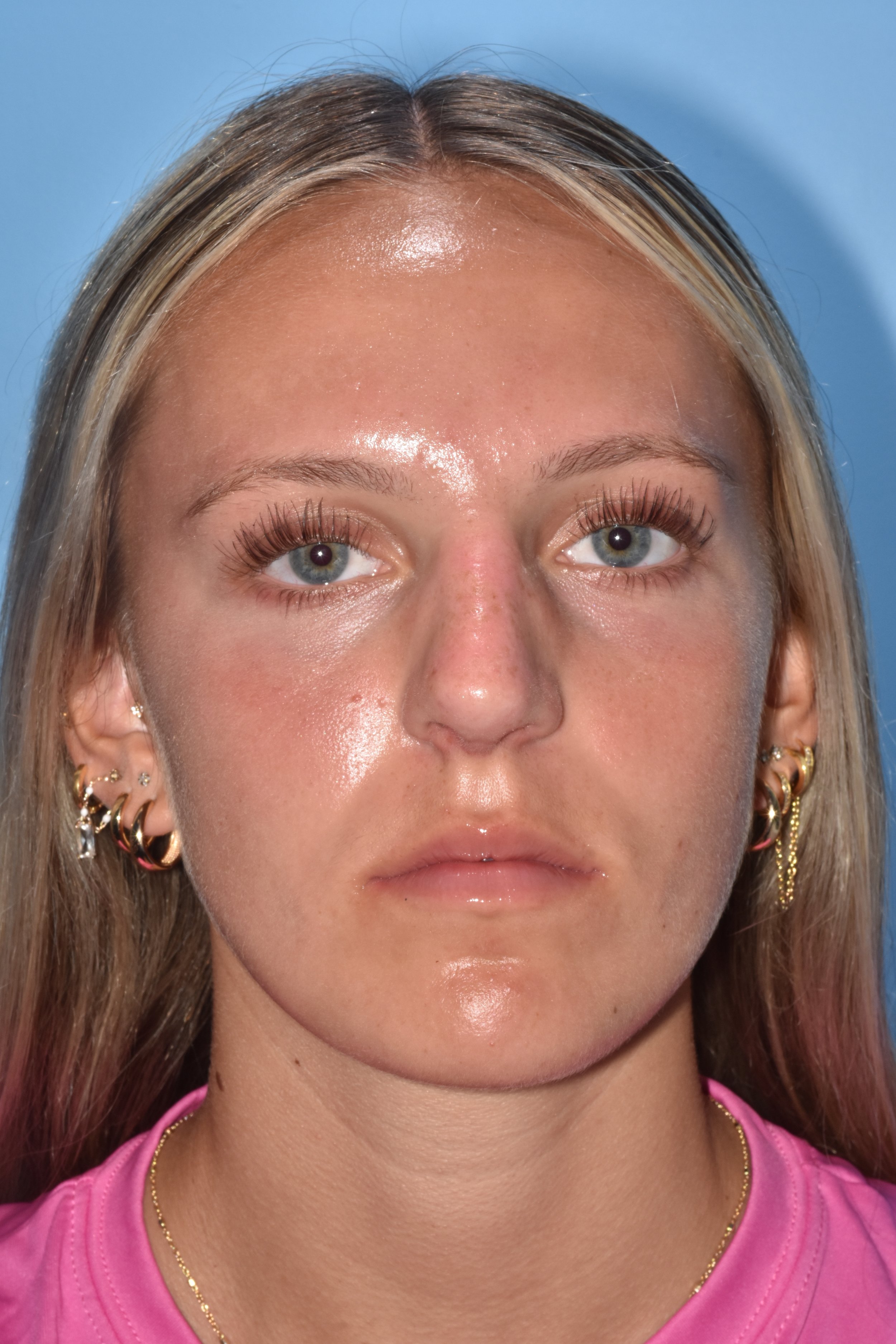 AFTER Rhinoplasty (dorsal reduction, eliminate soft tissue triangle depression at nostril apex) 