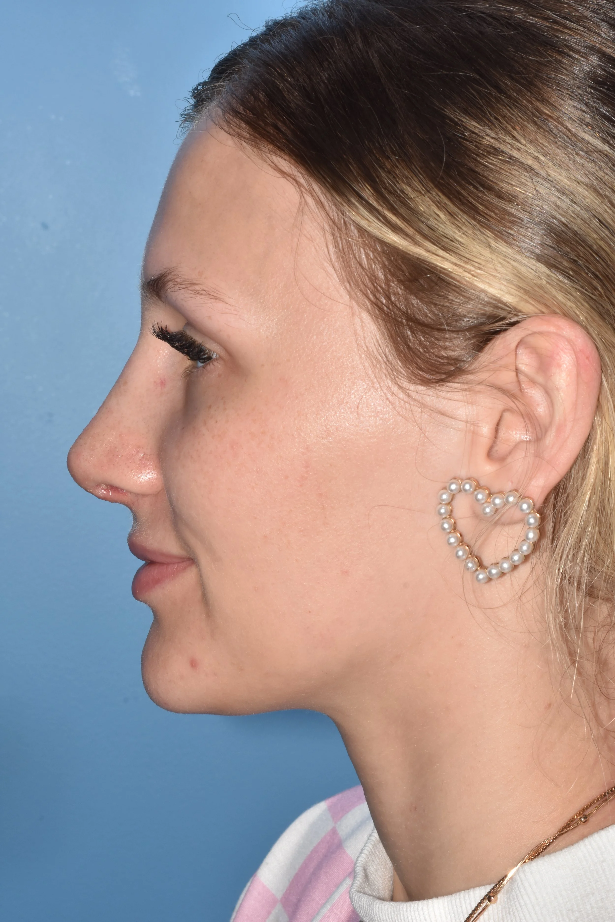 AFTER rhinoplasty (tip elevation, hump reduction)