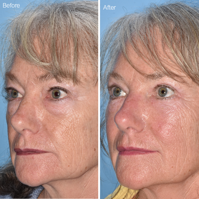 Eyelid and Brow Rejuvenation