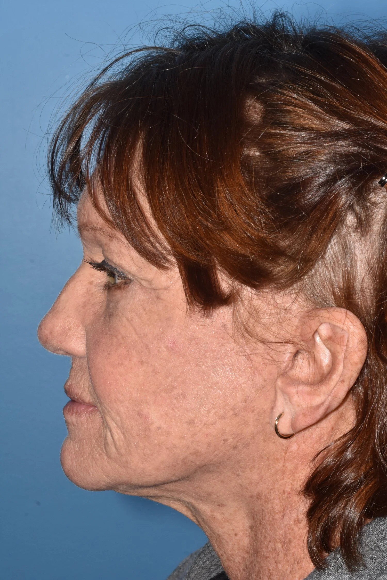 AFTER: deep plane face lift, fat reposition lower lid blepharoplasty