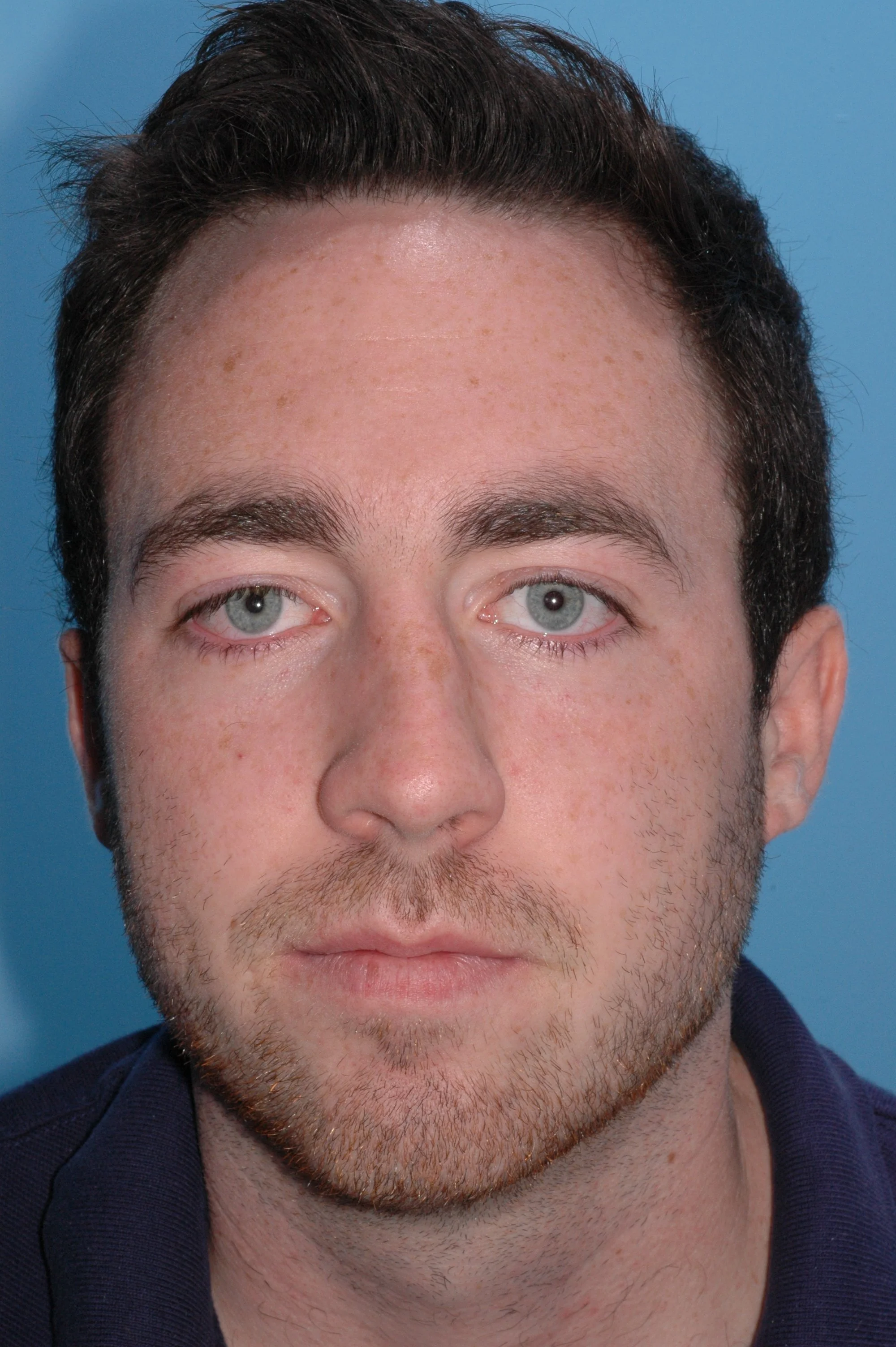 BEFORE: crooked nose, nasal airway obstruction