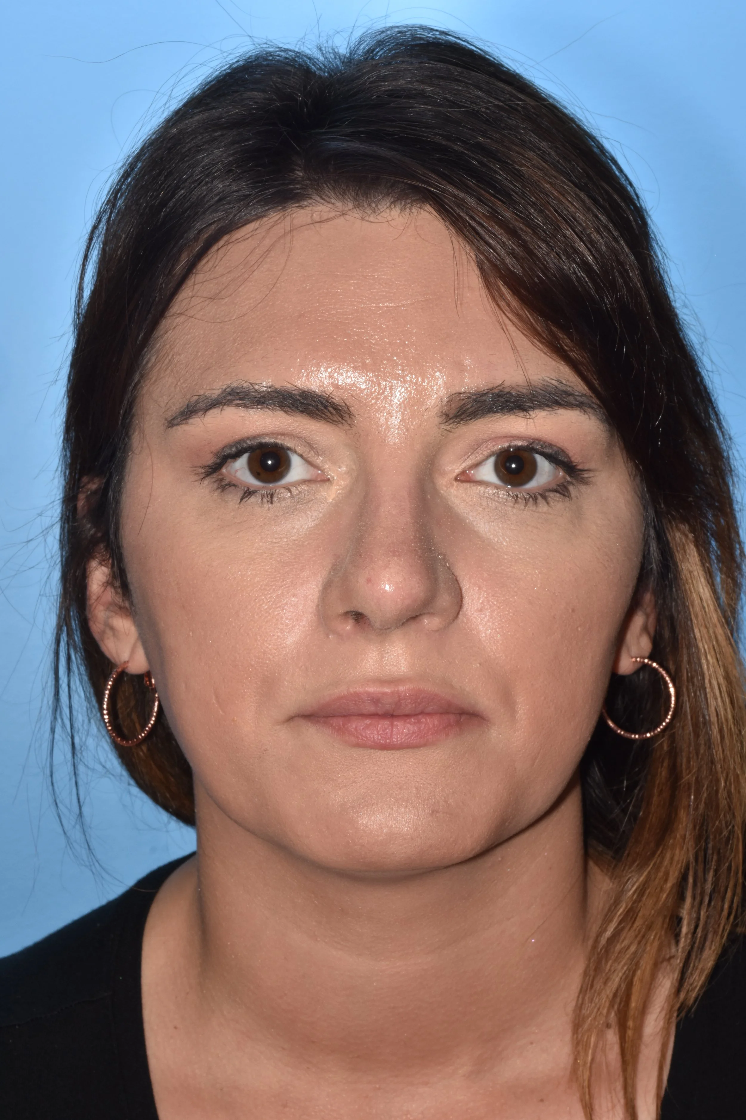 AFTER rhinoplasty (hump reduction, tip elevation, tip narrowing, straighter dorsum)