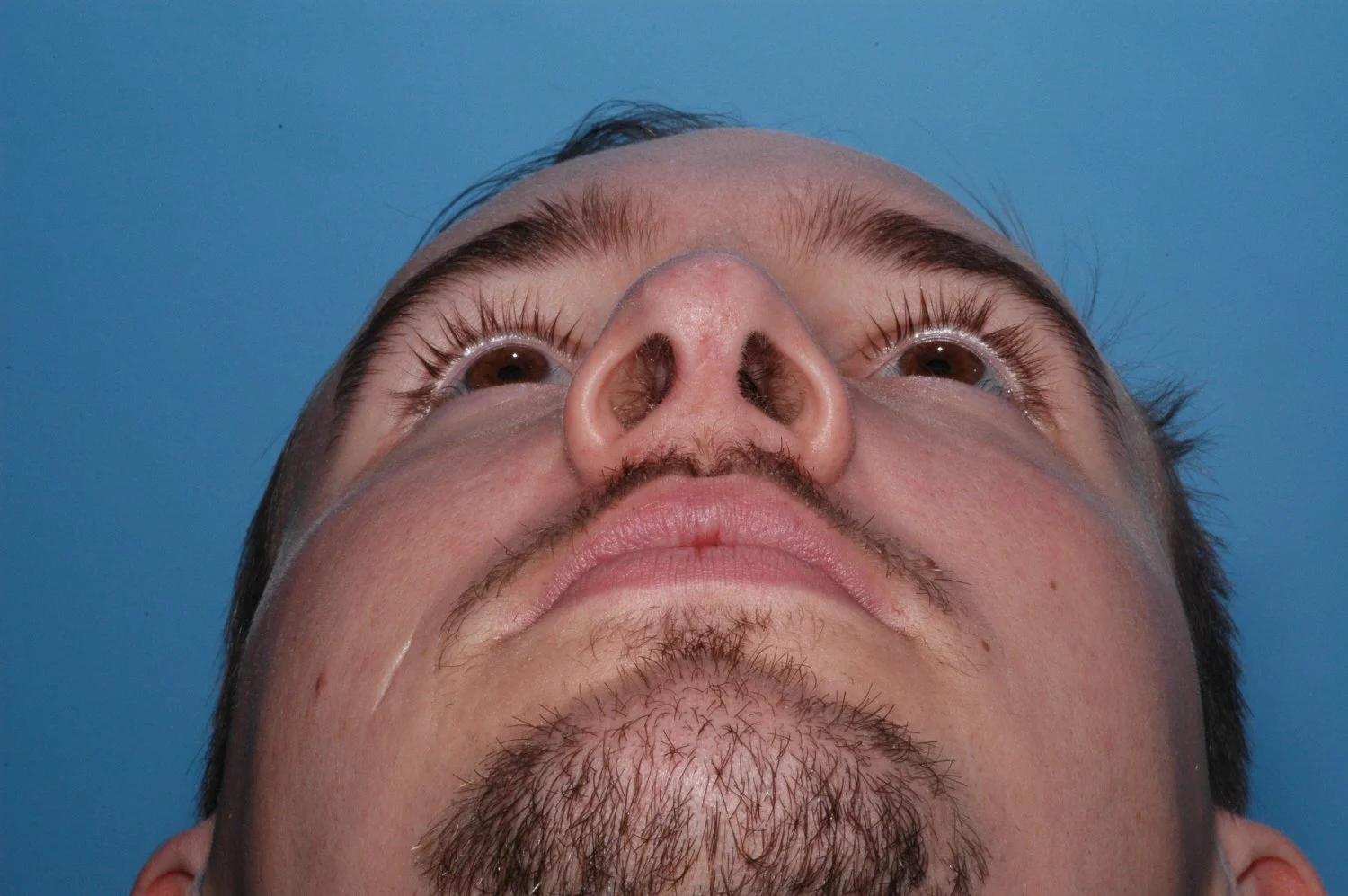 AFTER rhinoplasty: Double PDS
foil placed on the left side after weakening the cartilage to conform to it, nasal dorsum reduced, L cephalic turn-in, R cephalic trim, .
1.5 mm lateral crural overlap, bossae
softened over right tip-defining point, crus