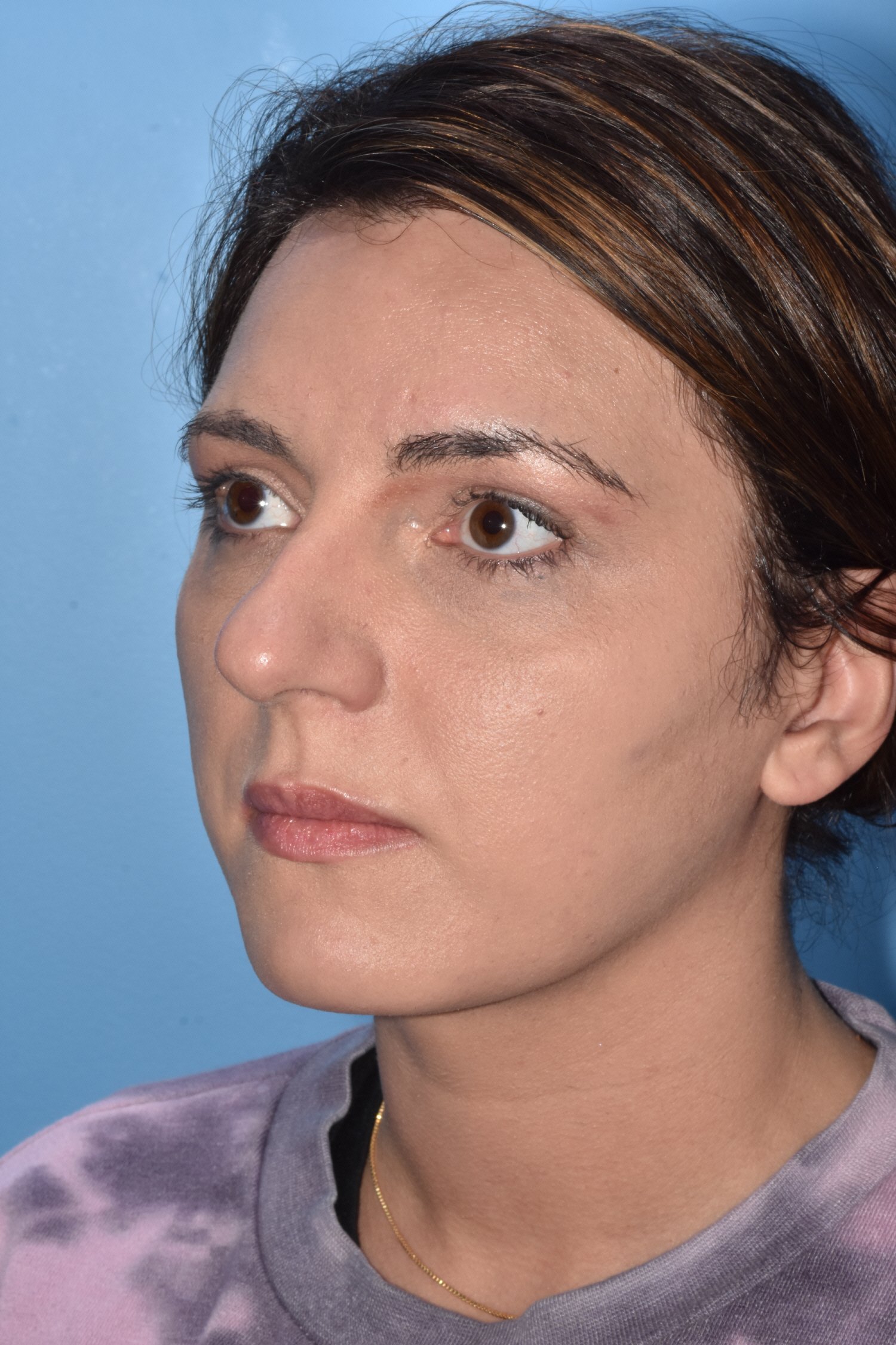 BEFORE rhinoplasty