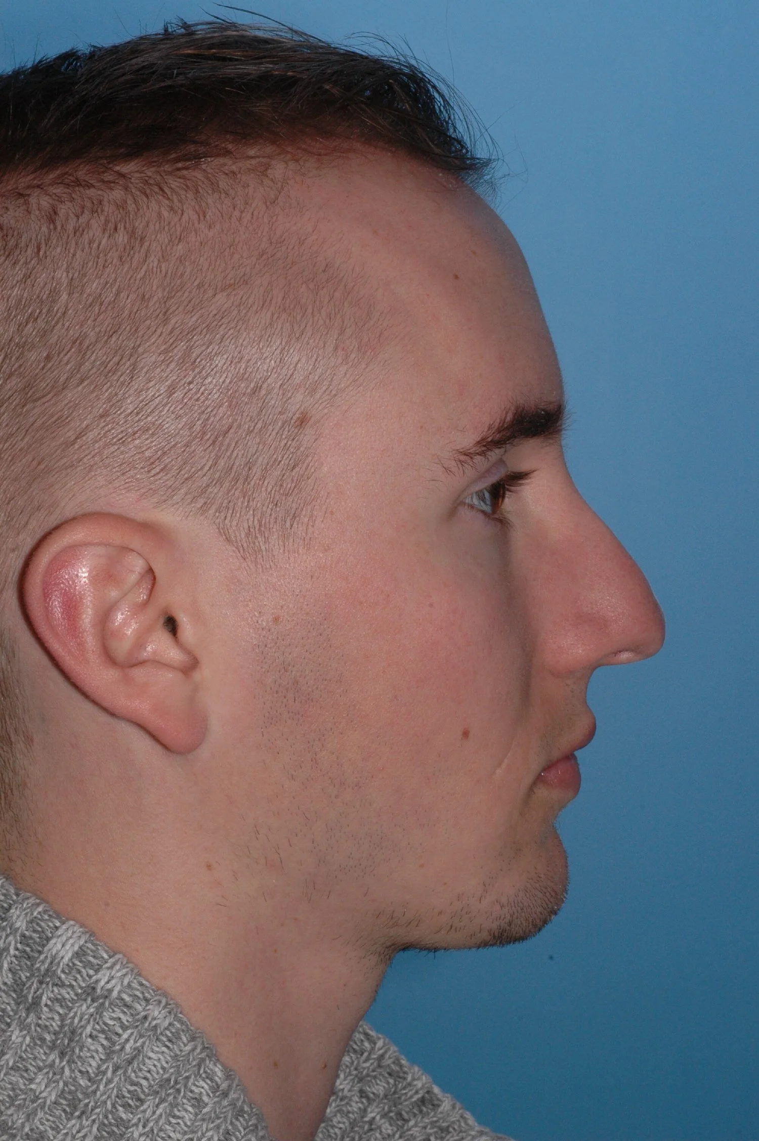 BEFORE rhinoplasty: tip twisted to L, dorsal hump, nostril asymmetry
