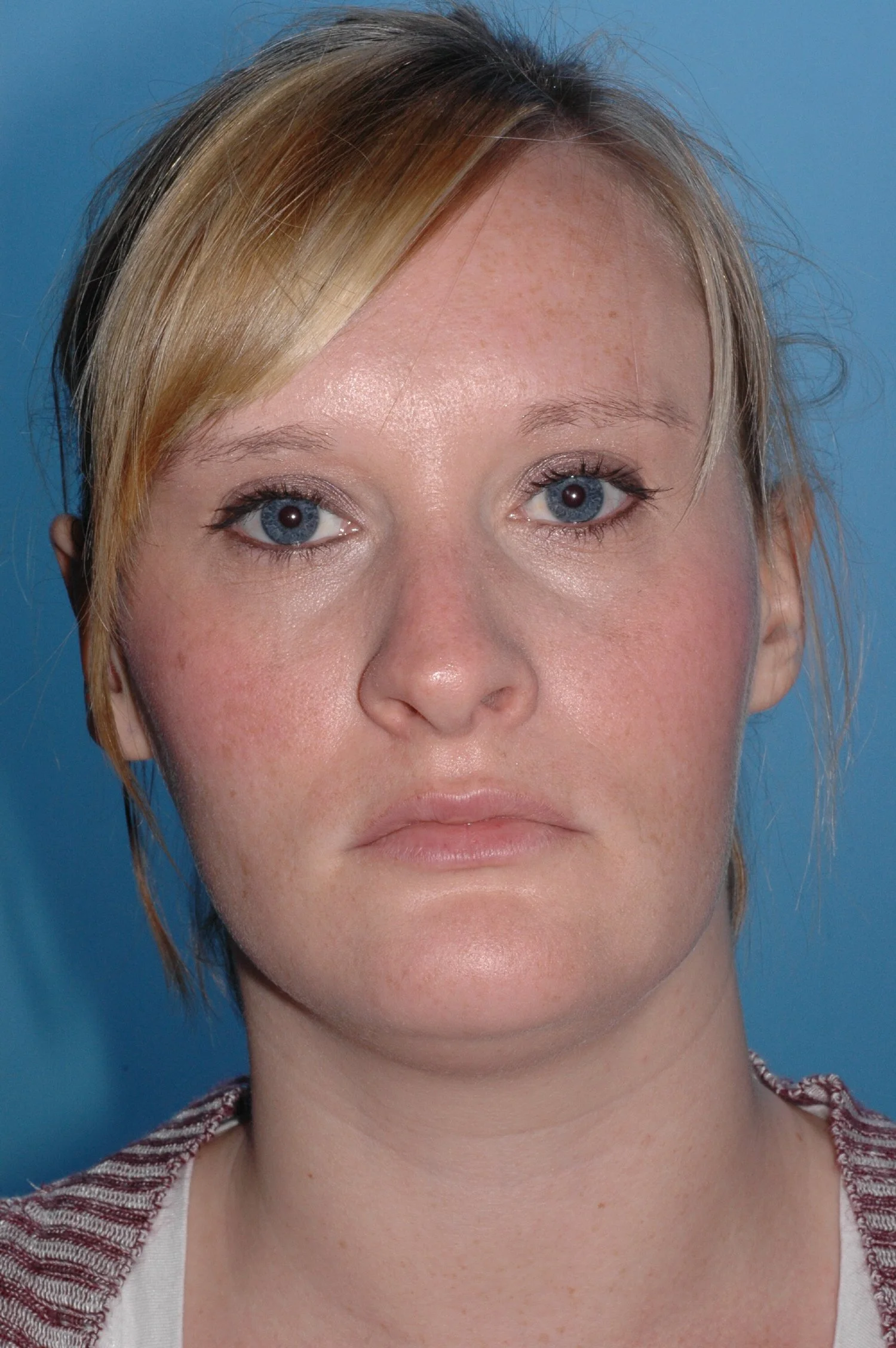 AFTER R otoplasty