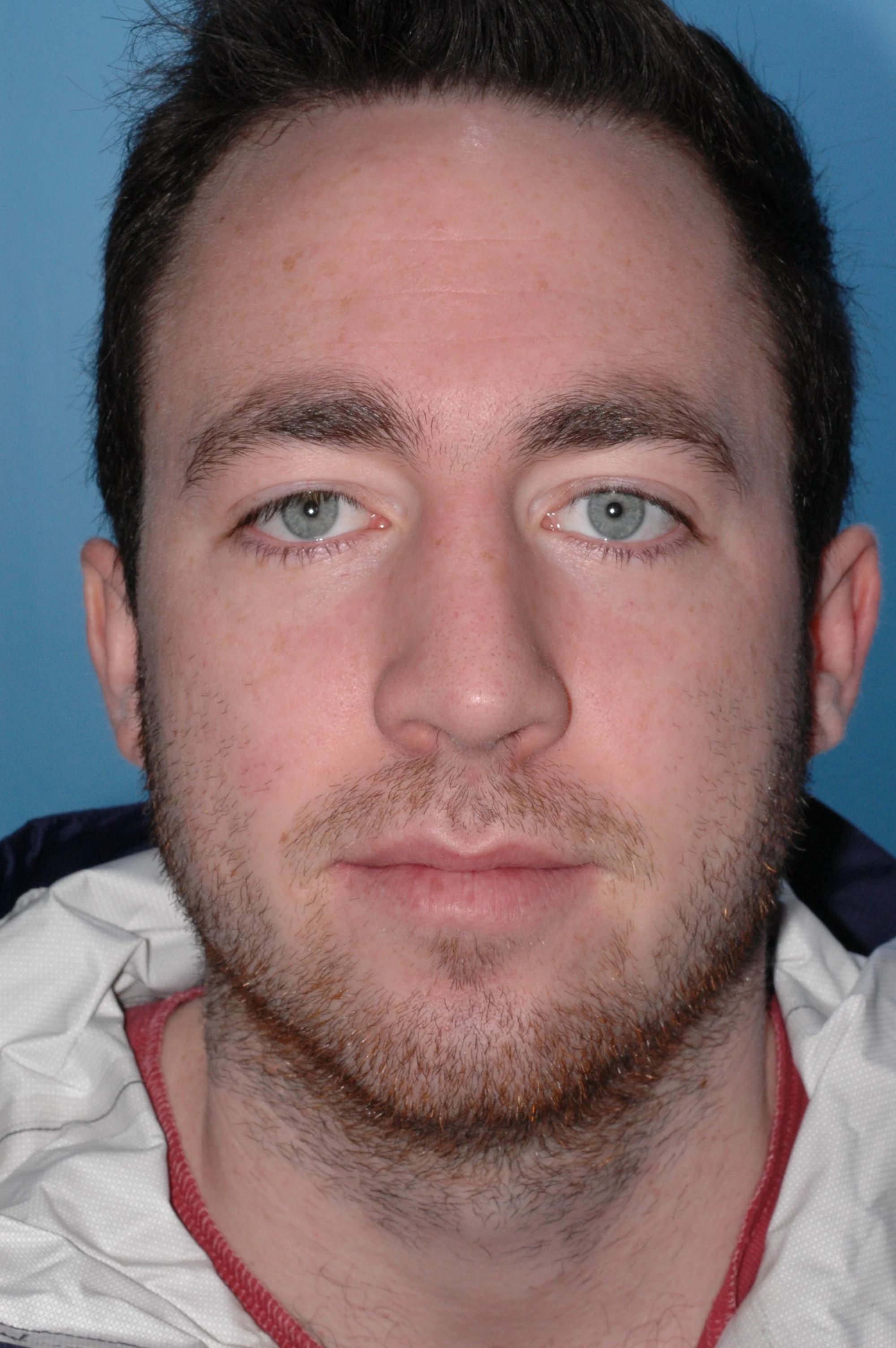 AFTER: straightening of nose