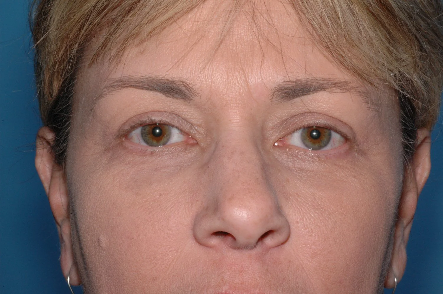 AFTER Upper lid blepharoplasty; notice increased "platform" show above the lash line.