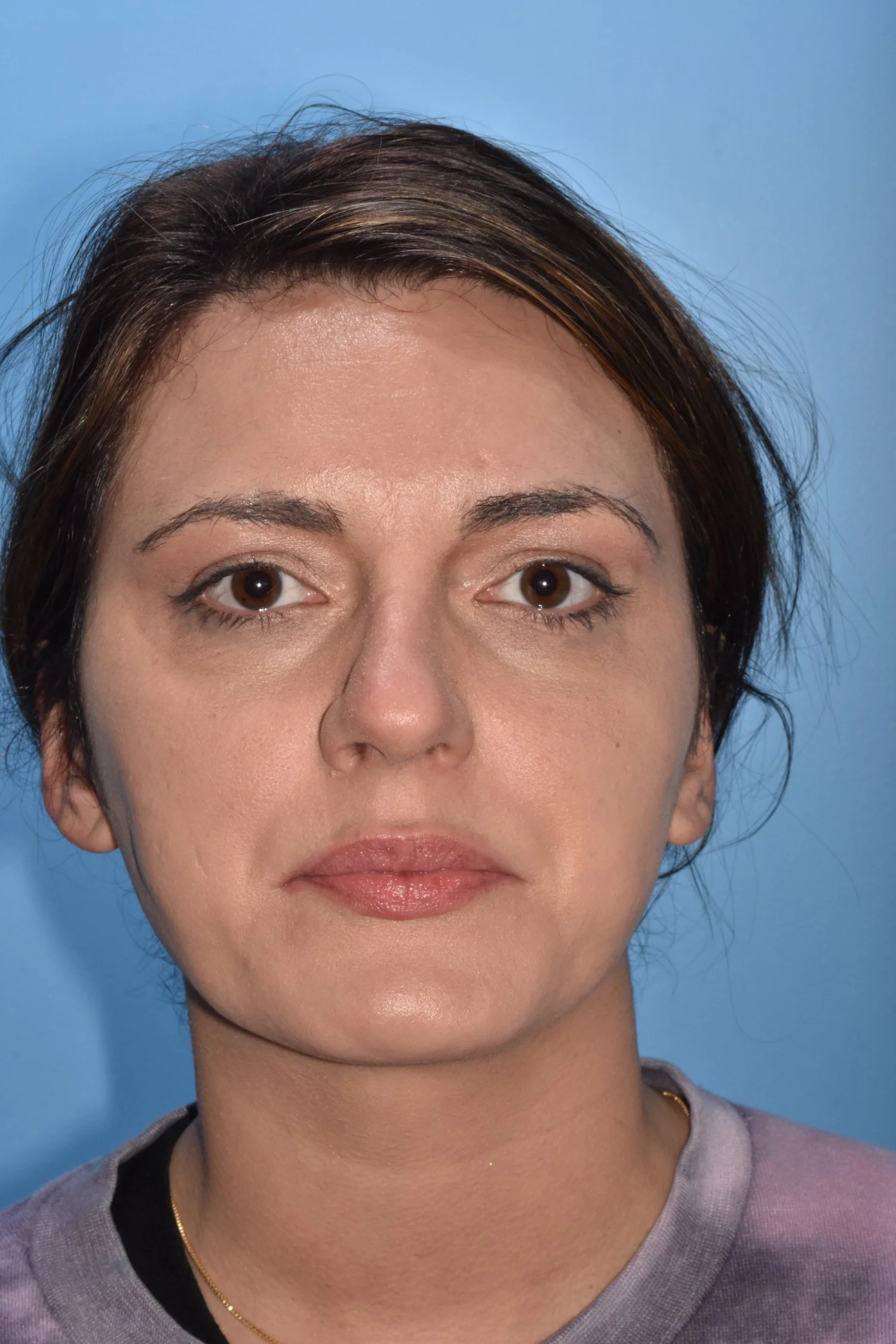 BEFORE rhinoplasty