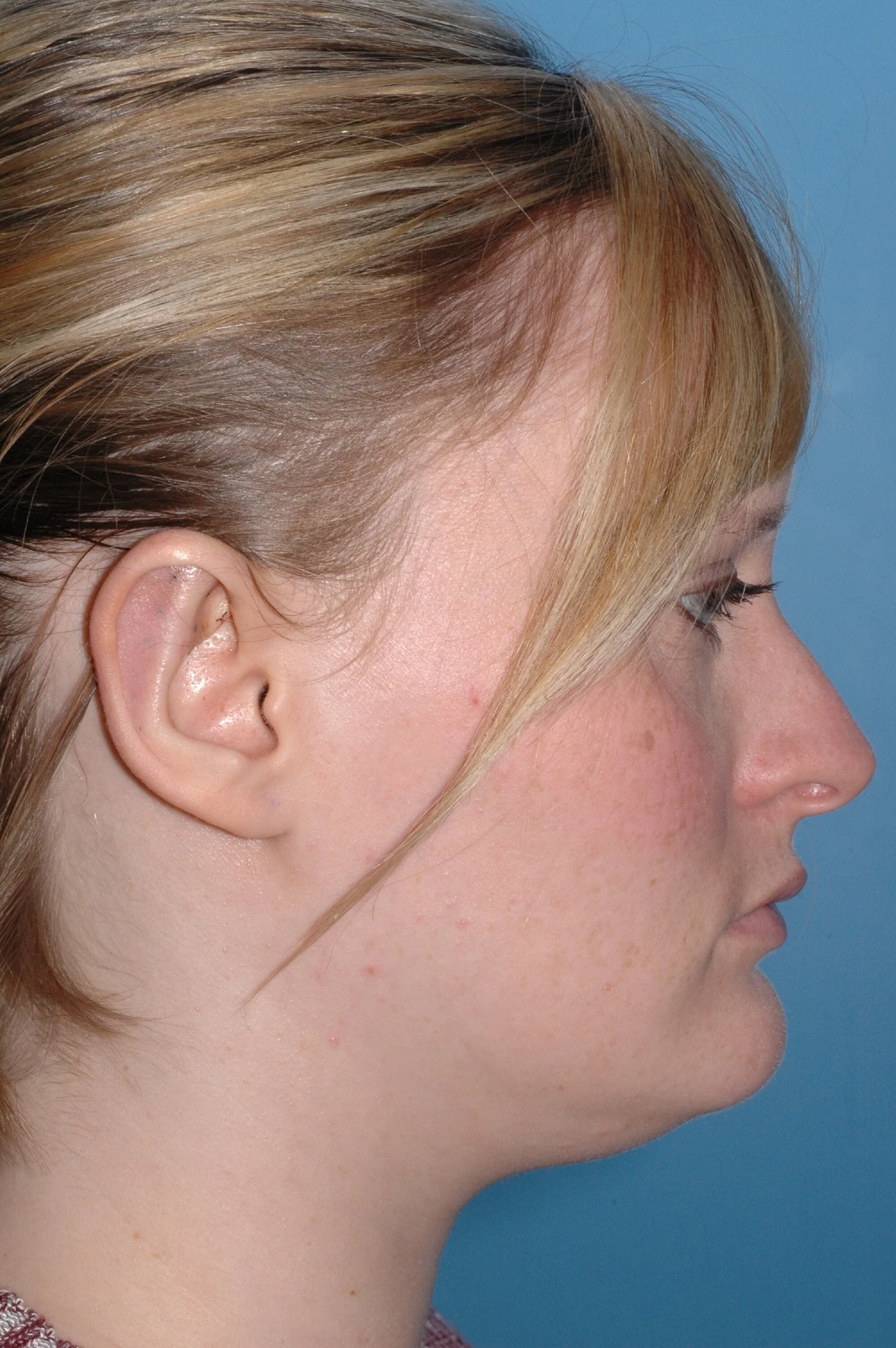 AFTER R otoplasty