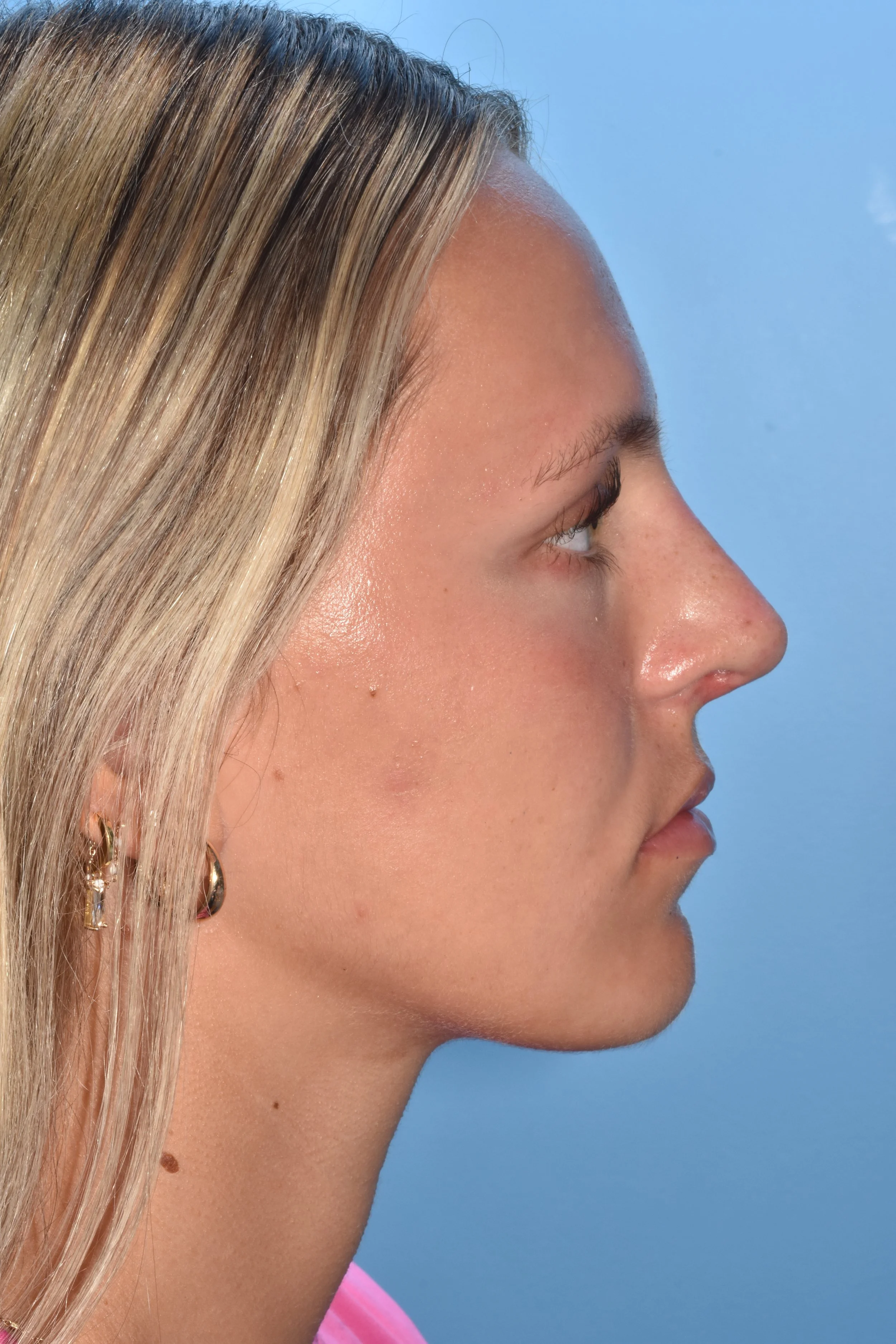 AFTER Rhinoplasty (dorsal reduction, eliminate soft tissue triangle depression at nostril apex) 
