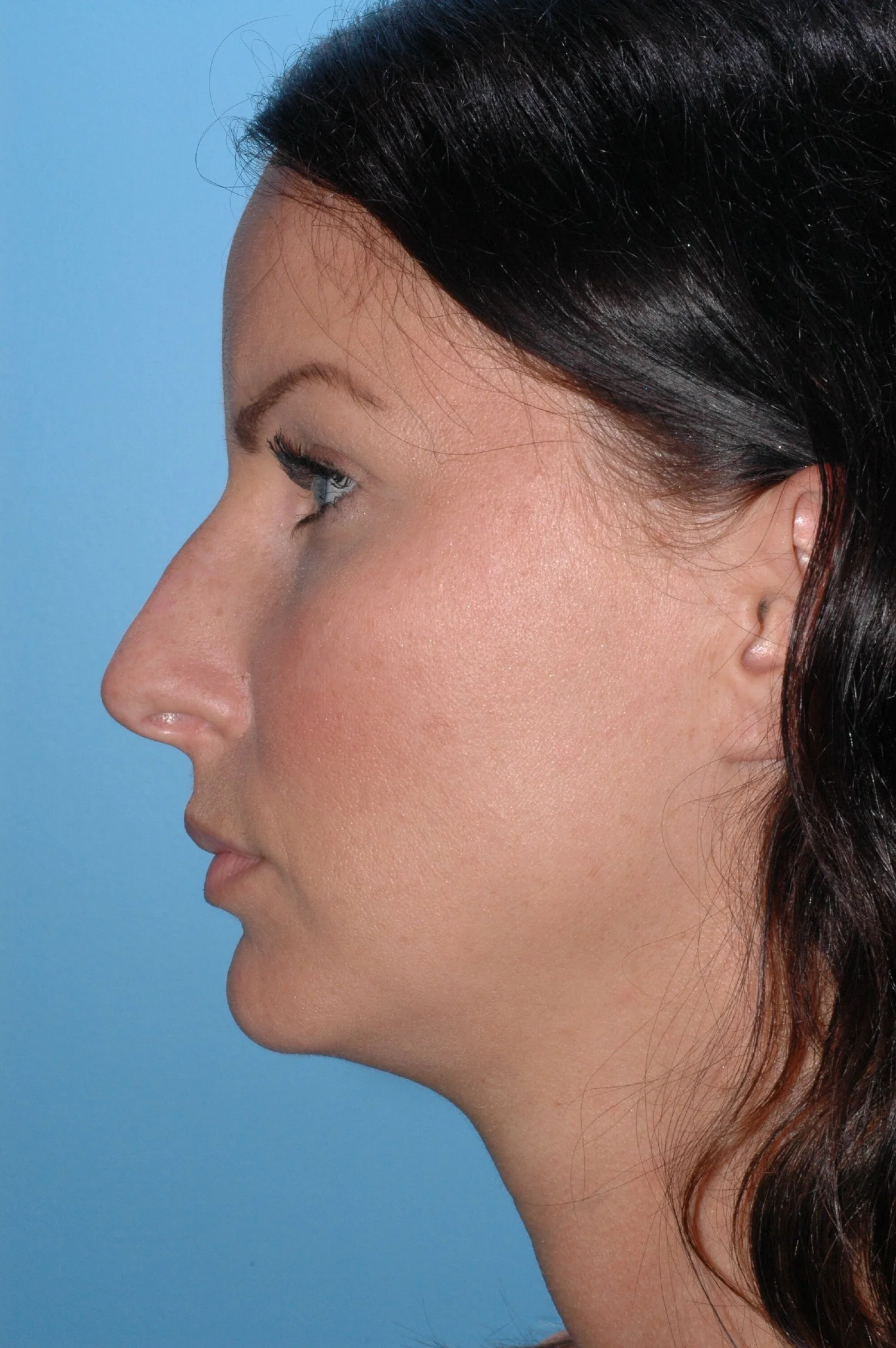 BEFORE rhinoplasty (overprojected dorsum,  functional issues)