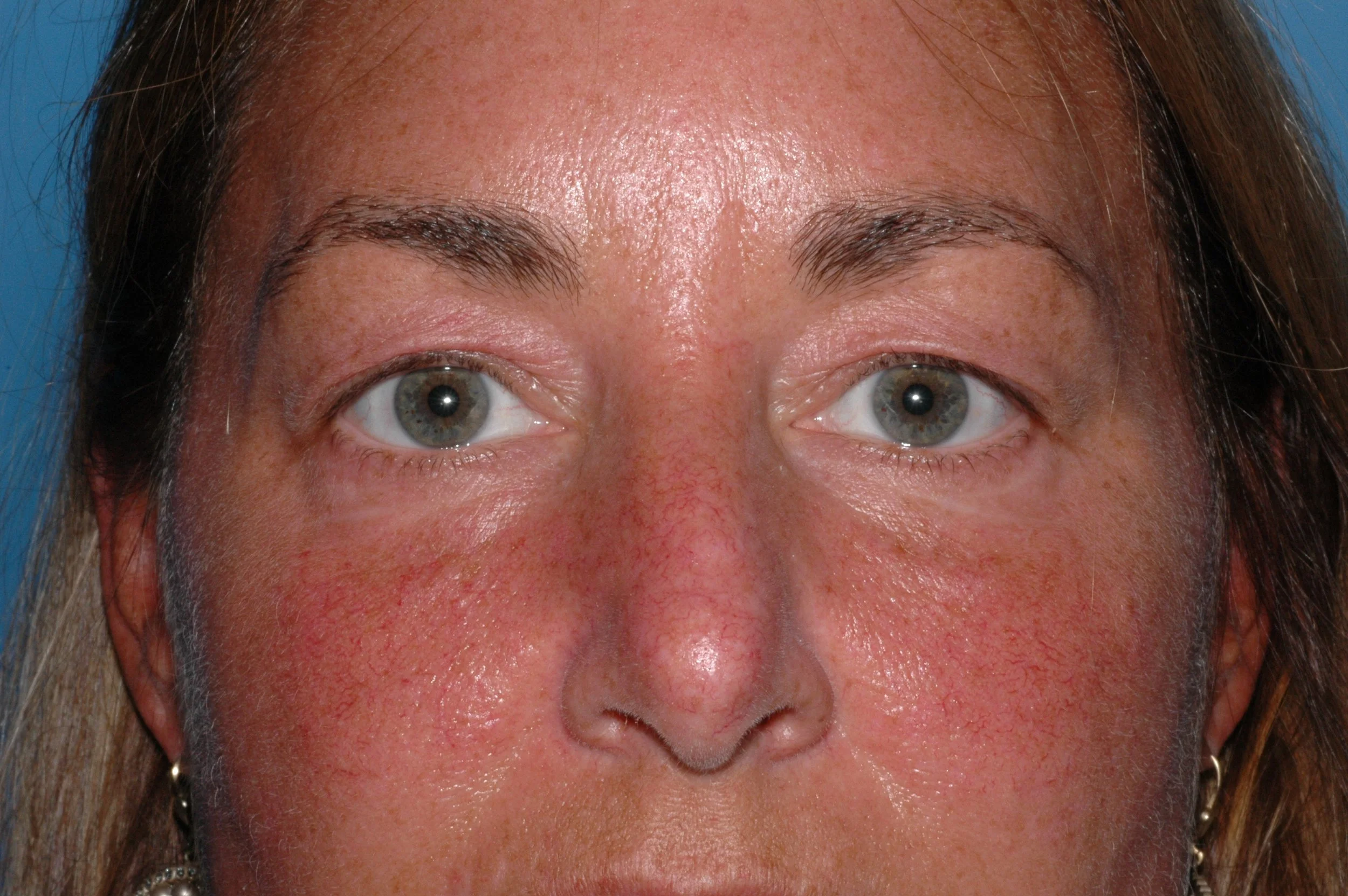 BEFORE upper eyelid blepharoplasty