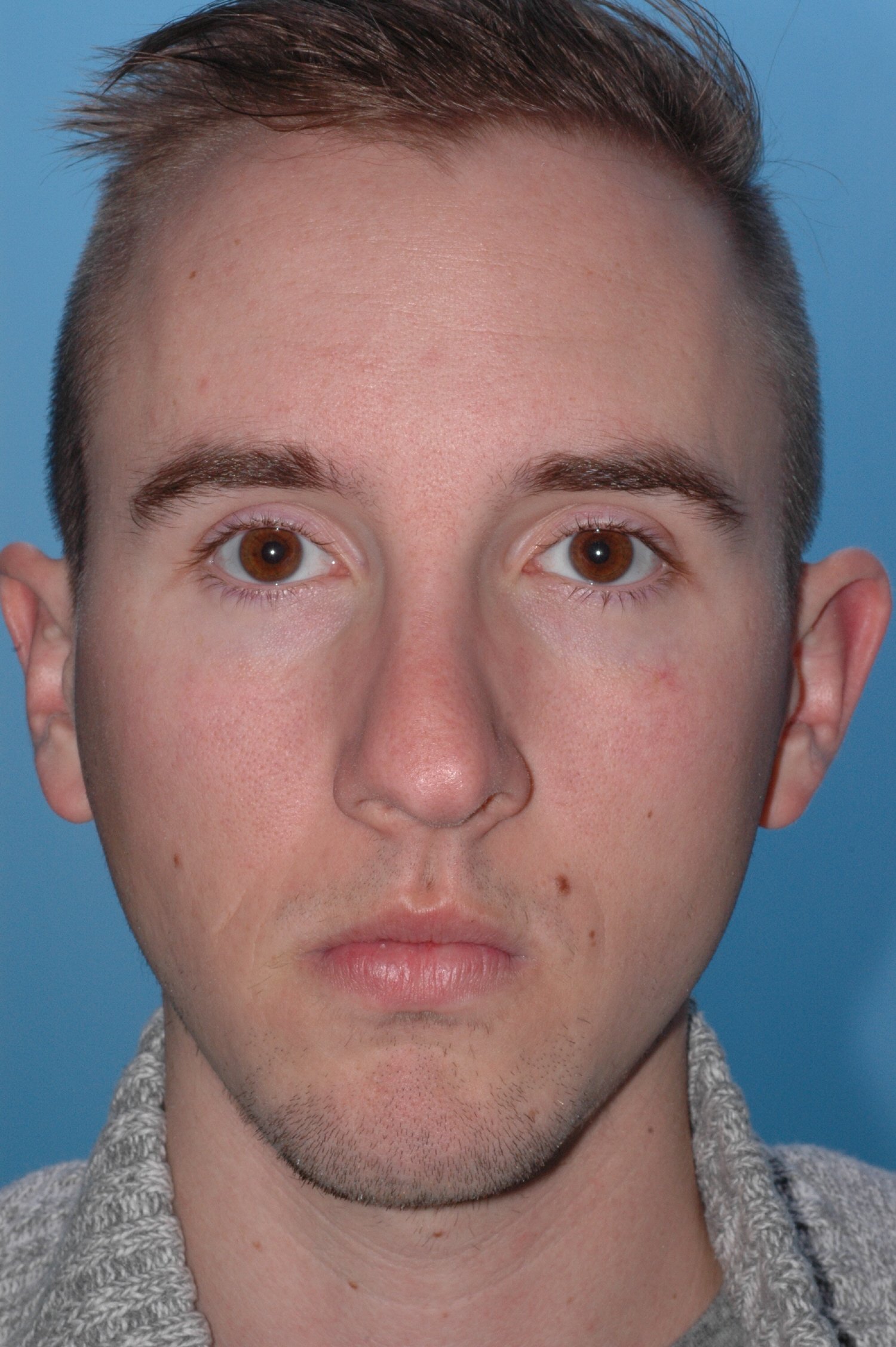 BEFORE rhinoplasty: tip twisted to L, dorsal hump, nostril asymmetry