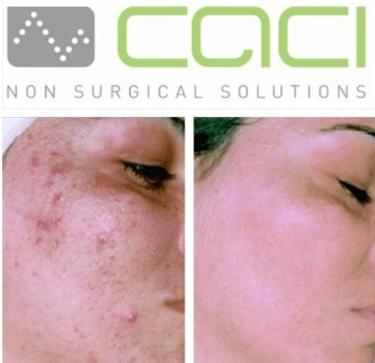 Comparison of a woman's face showing before and after skin treatment, with the logo of Caci Non Surgical Solutions at the top.