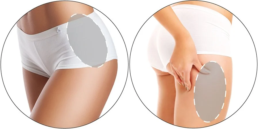 Two close-up images of a woman in white underwear, with the right side pointing to the inner thigh and buttock area, indicating pain or an issue in that region.
