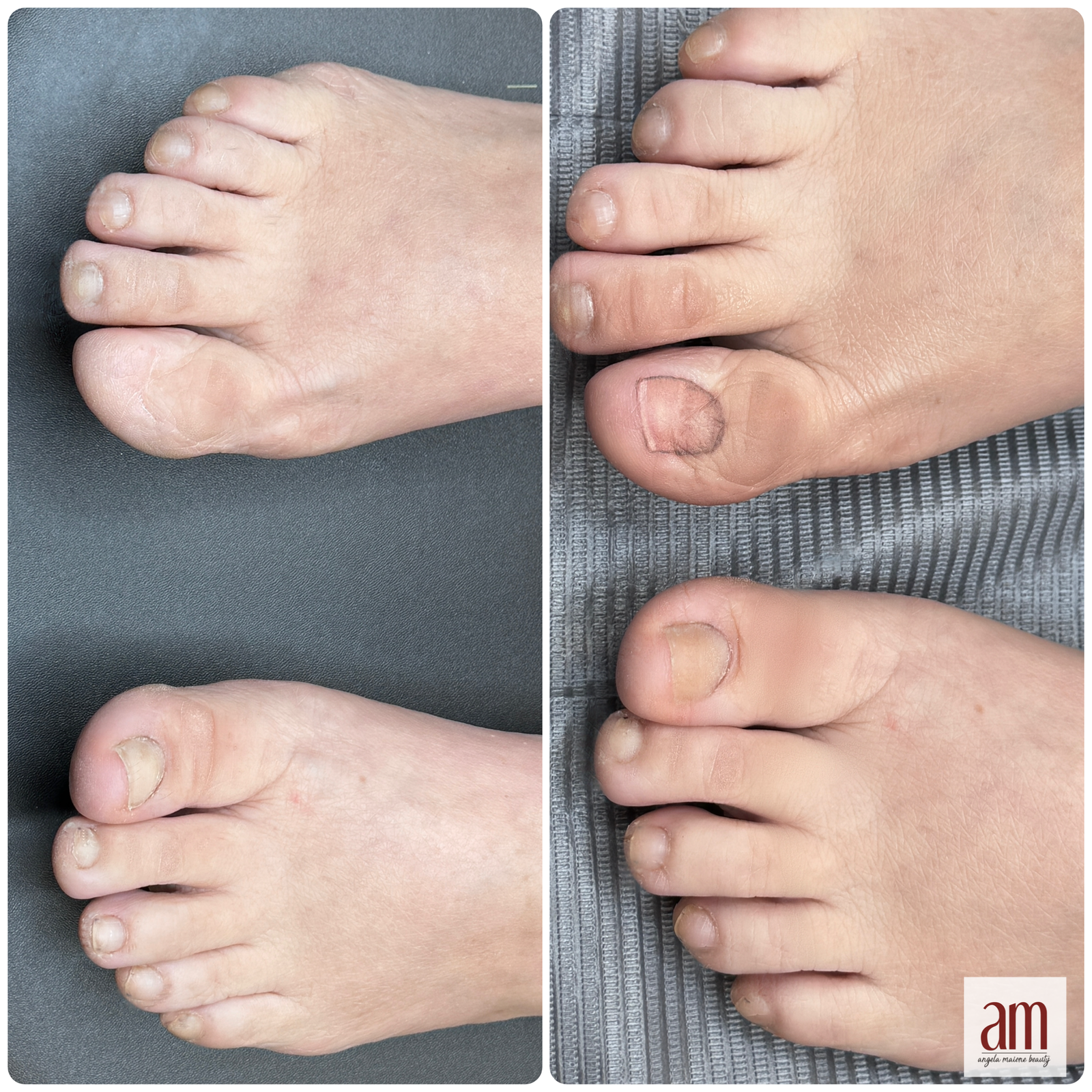 Restorative 3D toenail tattoo in Shelton CT