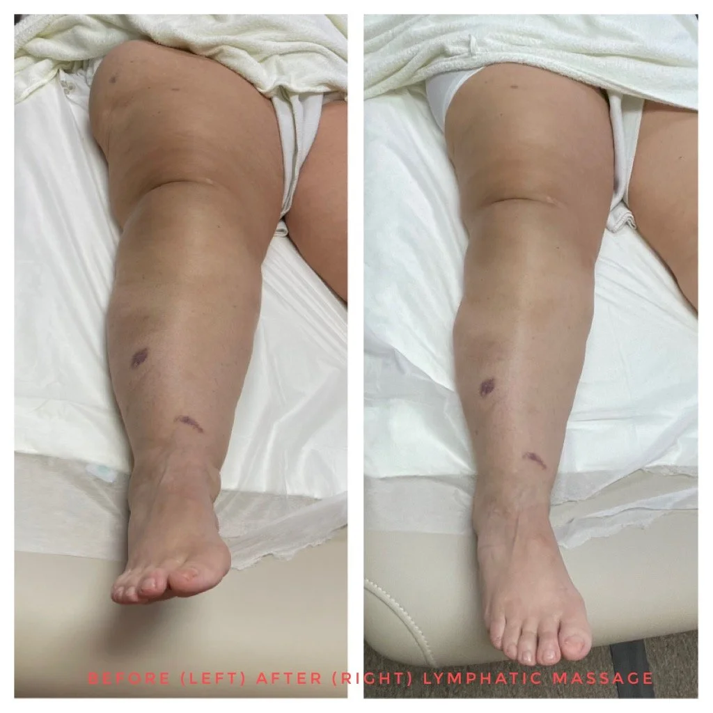 Pre and Post Lymphatic Massage Results