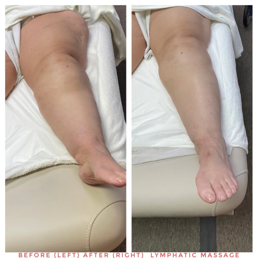 Pre and Post Lymphatic Massage Results