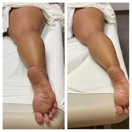 Pre and Post Lymphatic Massage Results