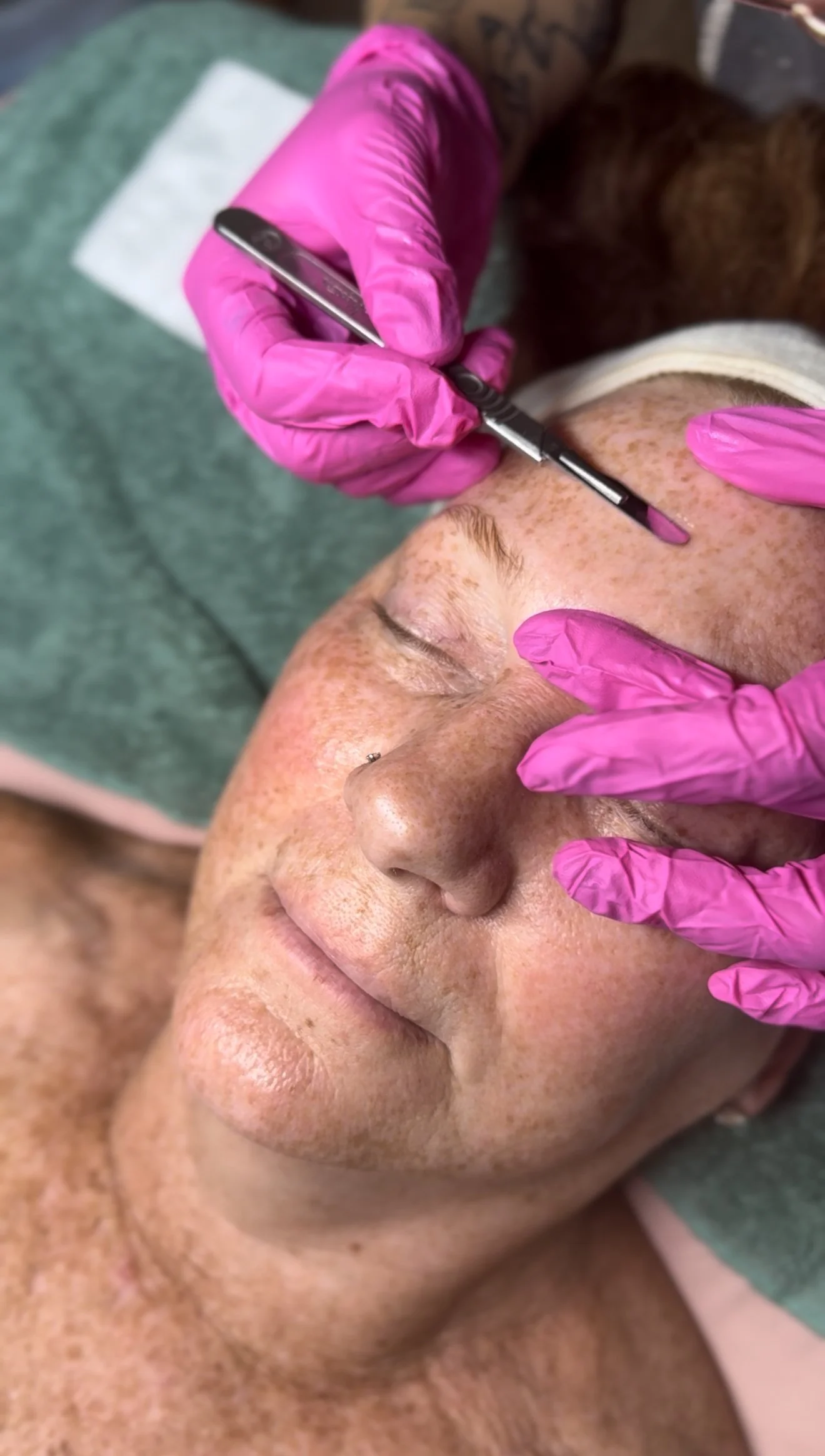 A person receiving a cosmetic procedure on their forehead with a small tool from a gloved hand, sitting relaxed with eyes closed.