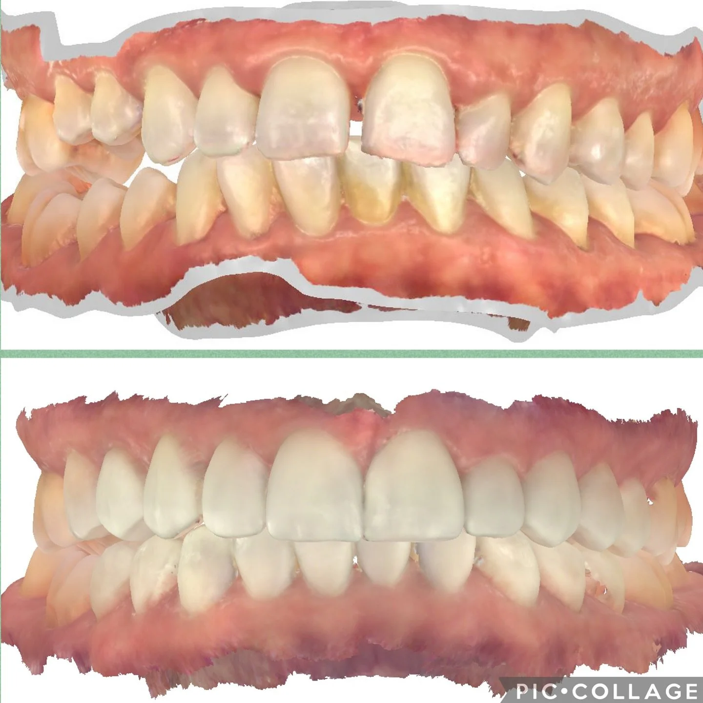 Quem disse que Invisalign n&atilde;o funciona??? 

Esse &eacute; um resultado lindo, tratamento complexo, 100% Invisalign na parte ortod&ocirc;ntica com parte est&eacute;tica no final. Paciente na tinha passado por v&aacute;rios tratamentos ortod&oci