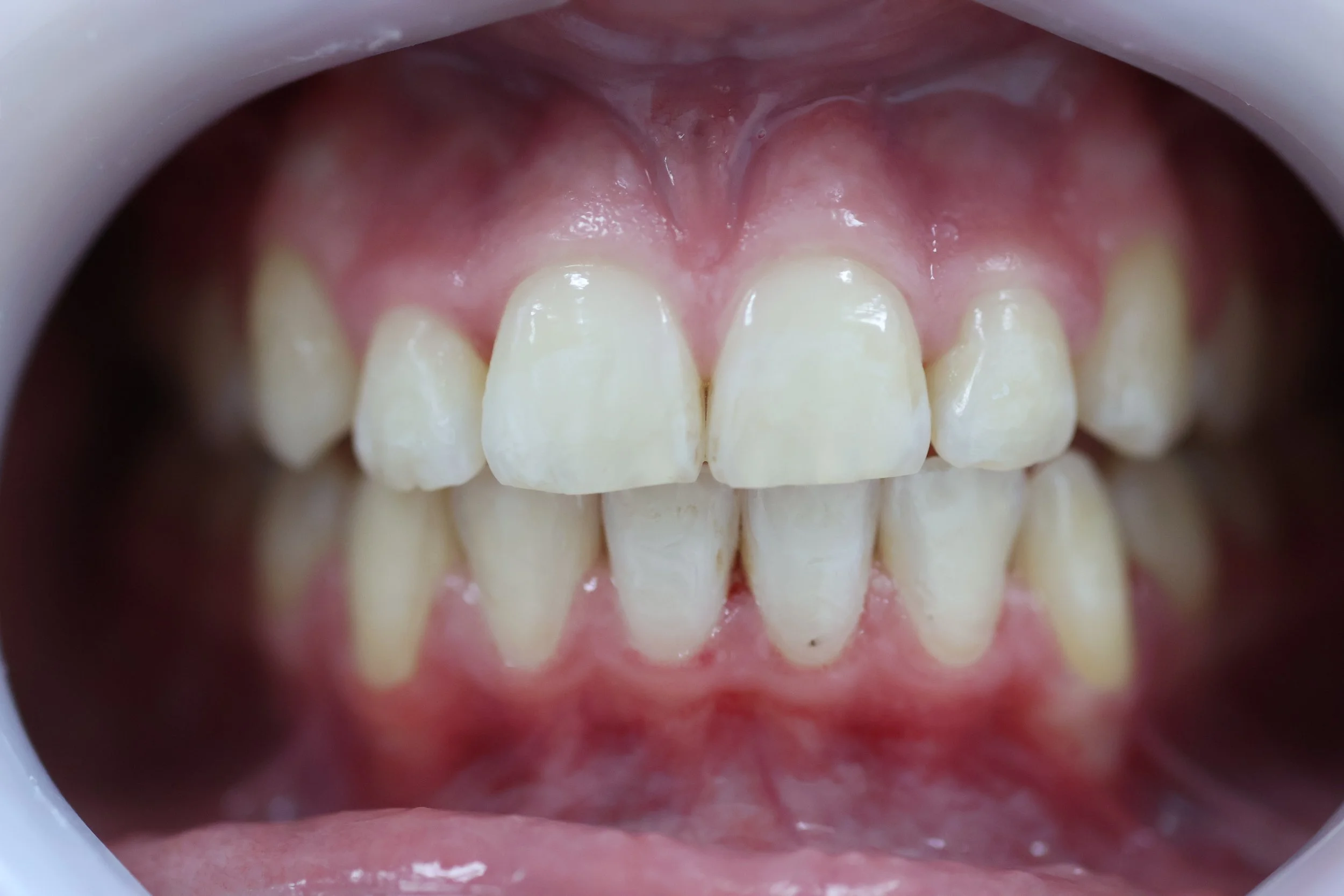 Close-up of a person's open mouth showing teeth and gums.